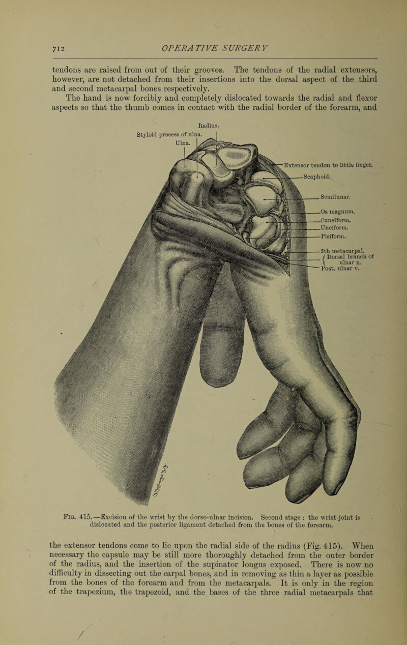 tendons are raised from out of their grooves. The tendons of the radial extensors, however, are not detached from their insertions into the dorsal aspect of the third and second metacarpal bones respectively. The hand is now forcibly and completely dislocated towards the radial and flexor aspects so that the thumb comes in contact with the radial border of the forearm, and Radius. Styloid process of ulna. Ulna. Semilunar. magnum. _Cuneiform. Pisiform. 5tli metacarpal. / Dorsal branch of ^ ulnar n. Post, ulnar v. Extensor tendon to little finger. Fig. 415.—Excision of the wrist by the dorso-ulnar incision. Second stage : the wrist-joint is dislocated and the posterior ligament detached from the bones of the forearm. the extensor tendons come to lie upon the radial side of the radius (Fig. 415). When necessary the capsule may be still more thoroughly detached from the outer border of the radius, and the insertion of the supinator longus exposed. There is now no difficulty in dissecting out the carpal bones, and in removing as thin a layer as possible from the bones of the forearm and from the metacarpals. It is only in the region of the trapezium, the trapezoid, and the bases of the three radial metacarpals that