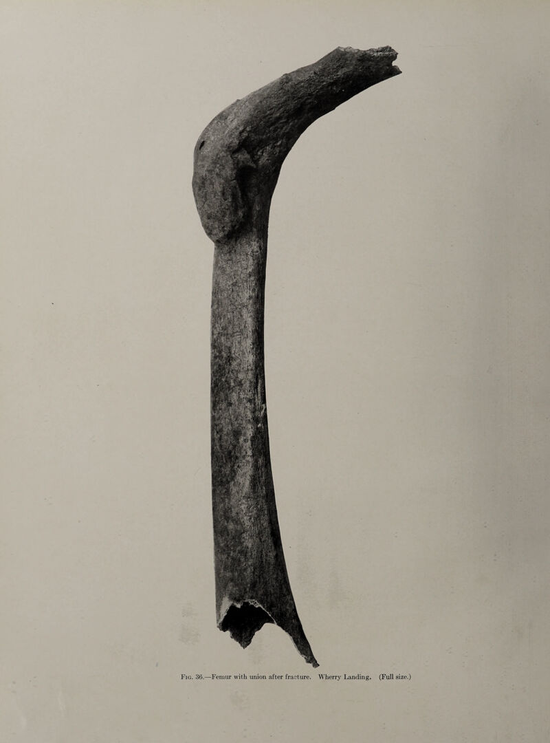 Fig. 36.—Femur with union after fracture. Wherry Landing. (Full size.)