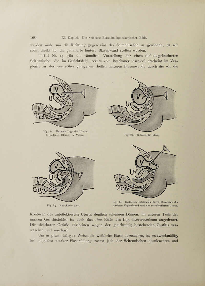 werden muß, um die Richtung- gegen eine der Seitennischen zu gewinnen, da wir sonst direkt auf die genäherte hintere Blasenwand stoßen würden. Tafel Nr. 14 gibt die räumliche Vorstellung der einen tief ausgebuchteten Seitennische, die im Gesichtsfeld, rechts vom Beschauer, dunkel erscheint im Ver¬ gleich zu der uns näher gelegenen, hellen hinteren Blasenwand, durch die wir die Fig. 84. Cystocele, entstanden durch Descensus der vorderen Vaginalwand und des retroflektierten Uterus. Konturen des anteflektierten Uterus deutlich erkennen können. Im unteren Teile des inneren Gesichtsfeldes ist auch das eine Ende des Li g. interuretericum angedeutet. Die sichtbaren Gefäße erscheinen wegen der gleichzeitig bestehenden Cystitis ver¬ waschen und unscharf. Um in planmäßiger Weise die weibliche Blase abzusuchen, ist es zweckmäßig, bei möglichst starker Blasenfüllung zuerst jede der Seitennischen abzuleuchten und