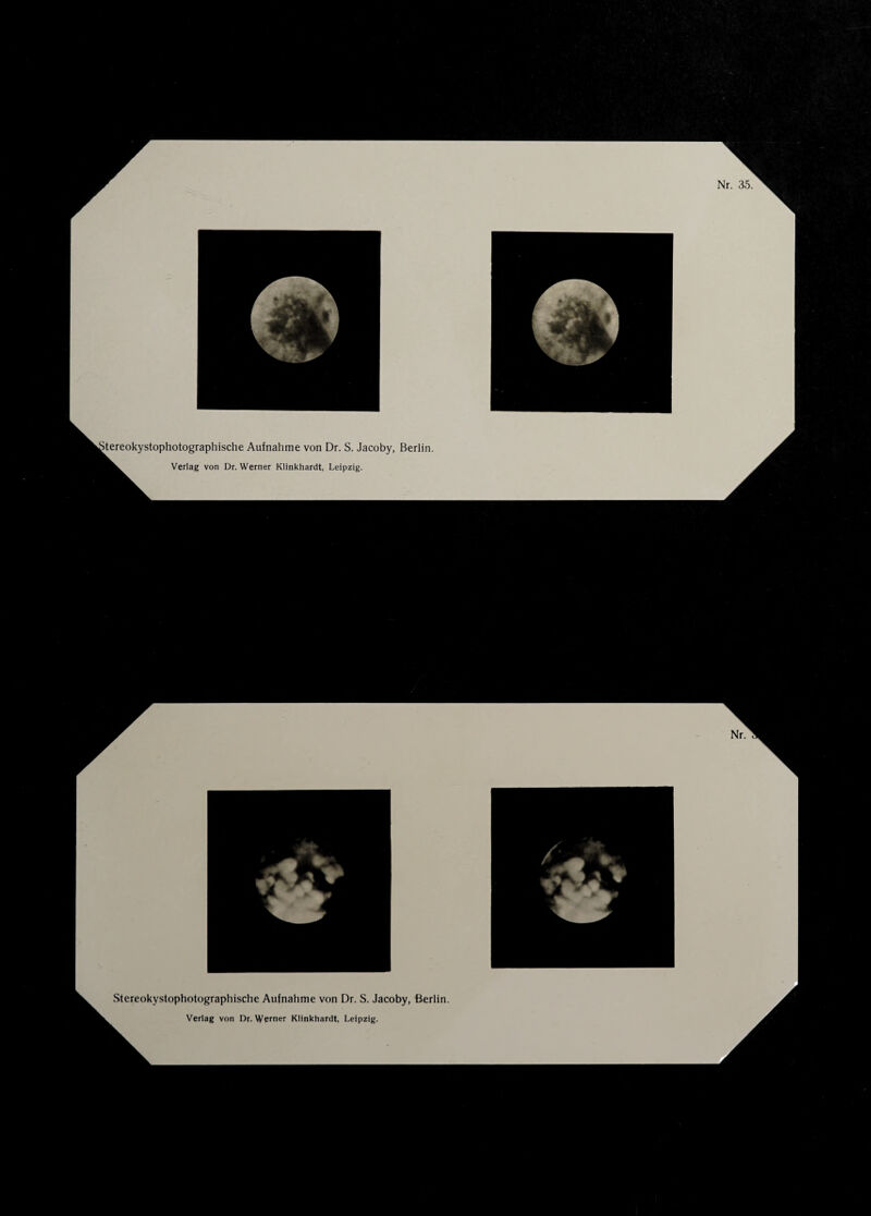 Stereokystophotographische Aufnahme von Dr. S. Jacoby, Berlin.