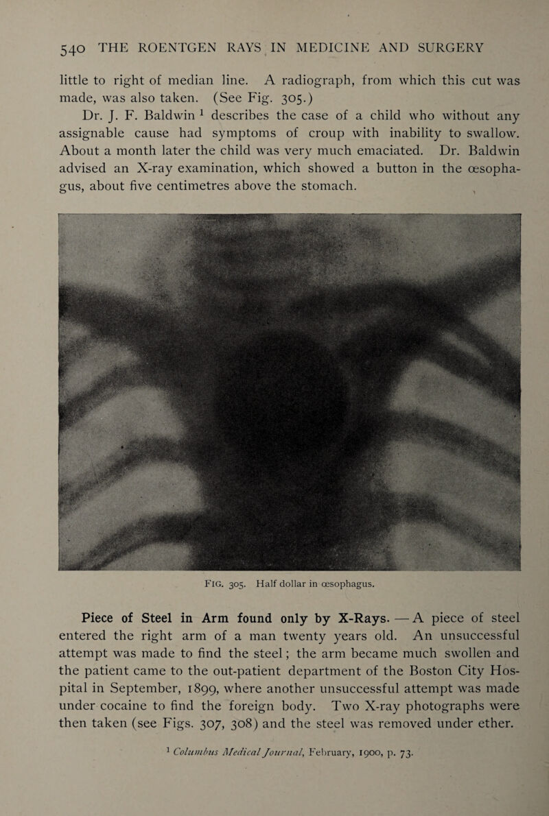 little to right of median line. A radiograph, from which this cut was made, was also taken. (See Fig. 305.) Dr. J. F. Baldwin 1 describes the case of a child who without any assignable cause had symptoms of croup with inability to swallow. About a month later the child was very much emaciated. Dr. Baldwin advised an X-ray examination, which showed a button in the oesopha¬ gus, about five centimetres above the stomach. Fig. 305. Half dollar in oesophagus. Piece of Steel in Arm found only by X-Rays. — A piece of steel entered the right arm of a man twenty years old. An unsuccessful attempt was made to find the steel; the arm became much swollen and the patient came to the out-patient department of the Boston City Hos¬ pital in September, 1899, where another unsuccessful attempt was made under cocaine to find the foreign body. Two X-ray photographs were then taken (see Figs. 307, 308) and the steel was removed under ether. 1 Columbus Medical Journal, February, 1900, p. 73.