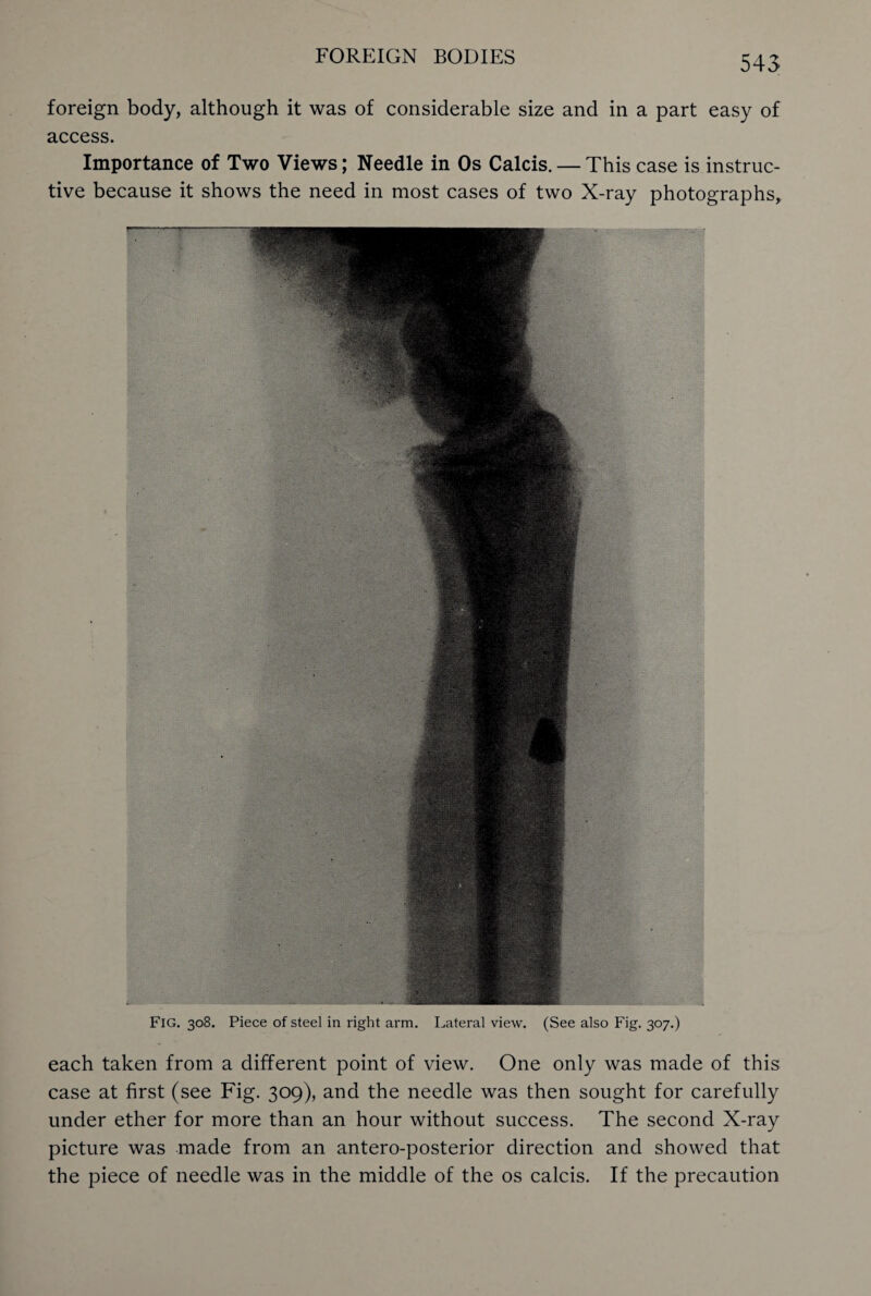 foreign body, although it was of considerable size and in a part easy of access. Importance of Two Views; Needle in Os Calcis. — This case is instruc¬ tive because it shows the need in most cases of two X-ray photographs,, v. Fig. 308. Piece of steel in right arm. Lateral view. (See also Fig. 307.) each taken from a different point of view. One only was made of this case at first (see Fig. 309), and the needle was then sought for carefully under ether for more than an hour without success. The second X-ray picture was made from an antero-posterior direction and showed that the piece of needle was in the middle of the os calcis. If the precaution