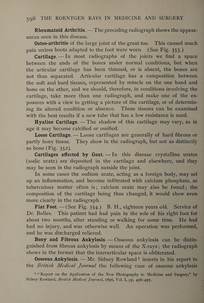 Rheumatoid Arthritis. —The preceding radiograph shows the appear¬ ances seen in this disease. Osteo-arthritis of the large joint of the great toe. This caused much pain unless boots adapted to the foot were worn. (See Fig. 353.) Cartilage. — In most radiographs of the joints we find a space between the ends of the bones under normal conditions, but when the articular cartilage has been thinned, or is absent, the bones are not thus separated. Articular cartilage has a composition between the soft and hard tissues, represented by muscle on the one hand and bone on the other, and we should, therefore, in conditions involving the cartilage, take more than one radiograph, and make one of the ex¬ posures with a view to getting a picture of the cartilage, or of determin¬ ing its altered condition or absence. These tissues can be examined with the best results if a new tube that has a low resistance is used. Hyaline Cartilage. — The shadow of this cartilage may vary, as in age it may become calcified or ossified. Loose Cartilage. — Loose cartilages are generally of hard fibrous or partly bony tissue. They show in the radiograph, but not as distinctly as bone (Fig. 352). Cartilages affected by Gout. — In this disease crystalline urates (sodic urate) are deposited in the cartilage and elsewhere, and they may be seen in the radiograph outside the joint. In some cases the sodium urate, acting as a foreign body, may set up an inflammation, and become infiltrated with calcium phosphate, as tuberculous matter often is; calcium urate may also be found; the composition of the cartilage being thus changed, it would show even more clearly in the radiograph. Flat Foot.—(See Fig. 354.) B. H., eighteen years old. Service of Dr. Bolles. This patient had had pain in the sole of his right foot for about two months, after standing or walking for some time. He had had no injury, and was otherwise well. An operation was performed, and he was discharged relieved. Bony and Fibrous Ankylosis. — Osseous ankylosis can be distin¬ guished from fibrous ankylosis by means of the X-rays; the radiograph shows in the former that the interarticular space is obliterated. Osseous Ankylosis. — Mr. Sidney Rowland 1 inserts in his report to the British Medical Journal the following case of osseous ankylosis 1 “ Report on the Application of the New Photography to Medicine and Surgery,” by Sidney Rowland, British Medical Journal, 1896, Vol. I, pp. 496-497.