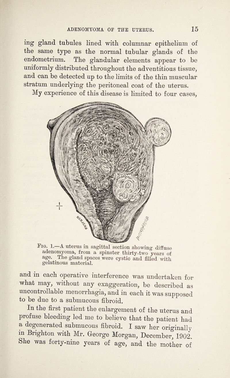 ing gland tubules lined with columnar epithelium of the same type as the normal tubular glands of the endometrium. The glandular elements appear to be uniformly distributed throughout the adventitious tissue, and can be detected up to the limits of the thin muscular stratum underlying the peritoneal coat of the uterus. My experience of this disease is limited to four cases. Fig, 1. A uterus in s&gittcil section showing diffuse adenomyoma, from a spinster thirty-two years of age. The gland spaces were cystic and filled with gelatinous material. and in each operative interference was undertaken for what may, without any exaggeration, be described as uncontrollable menorrhagia, and in each it was supposed to be due to a submucous fibroid. In the first patient the enlargement of the uterus and profuse bleeding led me to believe that the patient had a degenerated submucous fibroid. I saw her originally in Brighton with Mr. George Morgan, December, 1902. She was forty-nine years of age, and the mother of