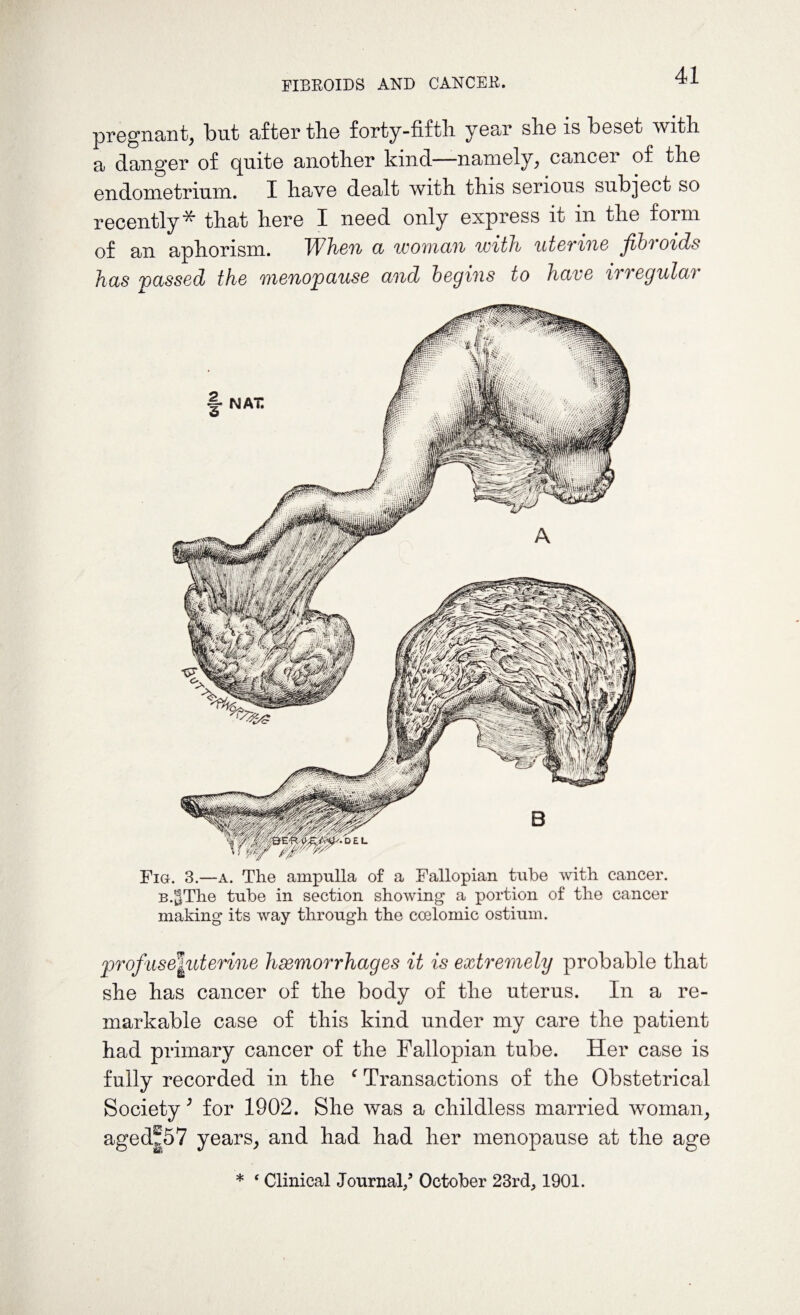FIBROIDS AND CANCER. pregnant, but after the forty-fifth year she is beset with a danger of quite another kind—namely, cancer of the endometrium. X have dealt with this serious subject so recently* that here I need only express it in the form of an aphorism. TVhen a woman with uterine jibi oids has passed the menopause and begins to have irregular Fig. 3.—a. The ampulla of a Fallopian tube with cancer. B.^The tube in section showing a portion of the cancer making its way through the coelomic ostium. profuse^uterine hemorrhages it is extremely probable that she has cancer of the body of the uterus. In a re¬ markable case of this kind under my care the patient had primary cancer of the Fallopian tube. Her case is fully recorded in the c Transactions of the Obstetrical Society ; for 1902. She was a childless married woman, aged®57 years, and had had her menopause at the age * ‘ Clinical Journal/ October 23rd, 1901.