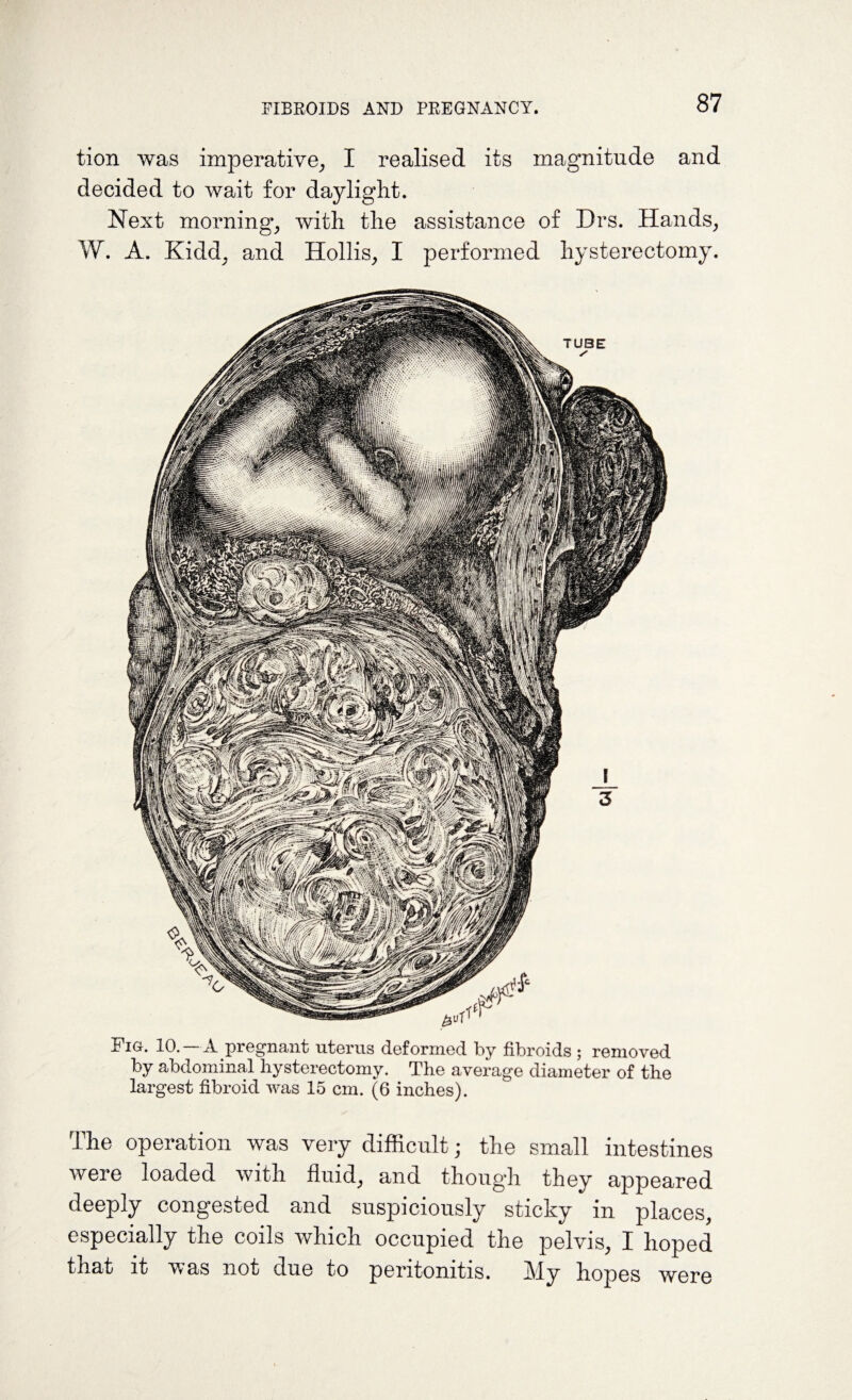 tion was imperative, I realised its magnitude and decided to wait for daylight. Next morning, with the assistance of Drs. Hands, W. A. Kidd, and Hollis, I performed hysterectomy. ITig. 10. A pregnant uterus deformed by fibroids ; removed by abdominal hysterectomy. The average diameter of the largest fibroid was 15 cm. (6 inches). The operation was very difficult; the small intestines were loaded with fluid, and though they appeared deeply congested and suspiciously sticky in places, especially the coils which occupied the pelvis, I hoped that it was not due to peritonitis. My hopes were