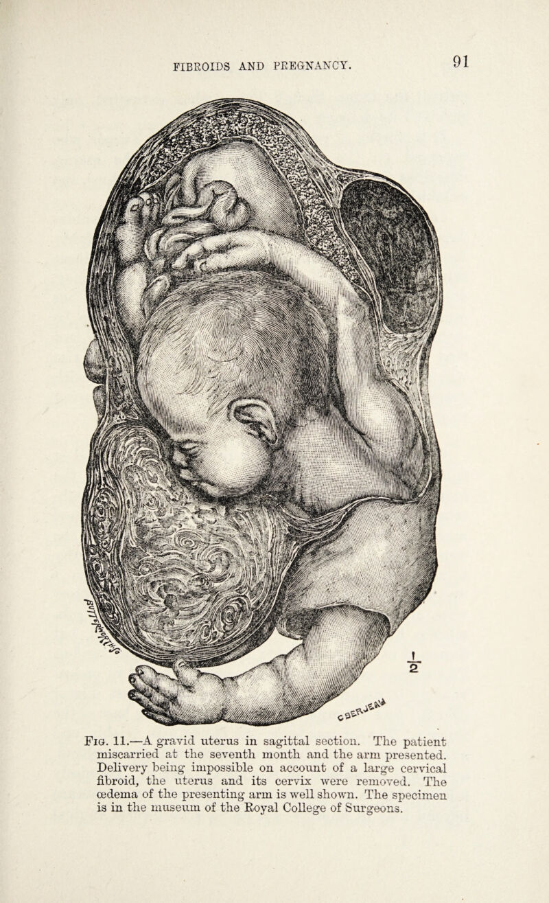 Fig. 11.—A gravid uterus in sagittal section. The patient miscarried at the seventh month and the arm presented. Delivery being impossible on account of a large cervical fibroid, the uterus and its cervix were removed. The oedema of the presenting arm is well shown. The specimen is in the museum of the Royal College of Surgeons.