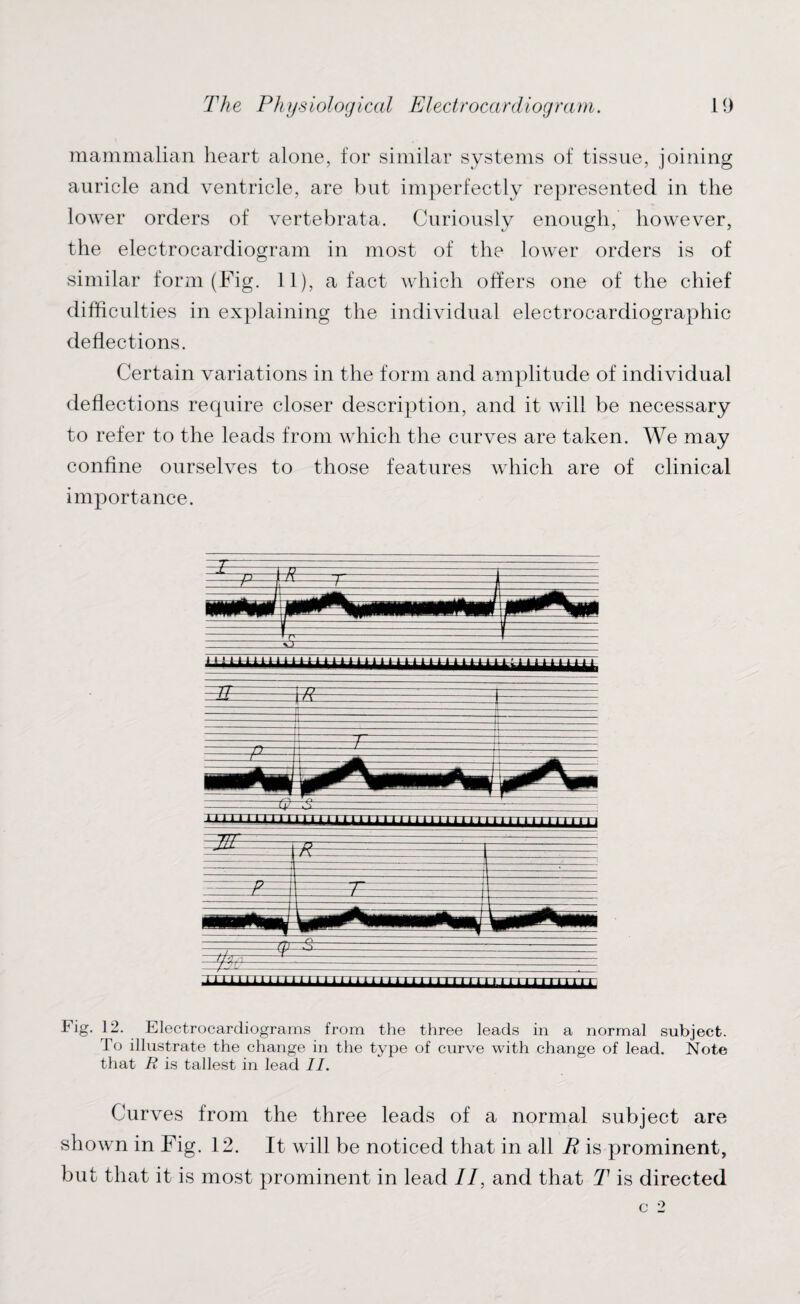 mammalian heart alone, for similar systems of tissue, joining auricle and ventricle, are but imperfectly represented in the lower orders of vertebrata. Curiously enough, however, the electrocardiogram in most of the lower orders is of similar form (Fig. 11), a fact which offers one of the chief difficulties in explaining the individual electrocardiographic deflections. Certain variations in the form and amplitude of individual deflections recpiire closer description, and it will be necessary to refer to the leads from which the curves are taken. We may confine ourselves to those features which are of clinical importance. ii;LUULitttiiiitlllllll1111 “ * *4 EUT \R —- - riTiiiirrraiiTi i minm 1111 mriri mu mini Fig. 12. Electrocardiograms from the three leads in a normal subject. To illustrate the change in the type of curve with change of lead. Note that R is tallest in lead II. Curves from the three leads of a normal subject are shown in Fig. 12. It will be noticed that in all R is prominent, but that it is most prominent in lead //, and that T is directed