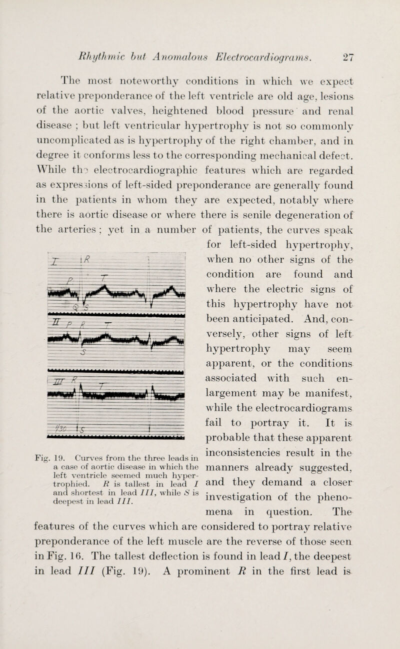 27 i R The most noteworthy conditions in which we expect relative preponderance of the left ventricle are old age, lesions of the aortic valves, heightened blood pressure and renal disease ; but left ventricular hypertrophy is not so commonly uncomplicated as is hypertrophy of the right chamber, and in degree it conforms less to the corresponding mechanical defect. While the electrocardiographic features which are regarded as expressions of left-sided preponderance are generally found in the patients in whom they are expected, notably where there is aortic disease or where there is senile degeneration of the arteries ; yet in a number of patients, the curves speak for left-sided hypertrophy, when no other signs of the condition are found and where the electric signs of this hypertrophy have not been anticipated. And, con- versely, other signs of left hypertrophy may seem apparent, or the conditions associated with such en¬ largement may be manifest, while the electrocardiograms fail to portray it. It is probable that these apparent inconsistencies result in the manners already suggested, and they demand a closer Fig. 10. Curves from the three leads in a case of aortic disease in which the left ventricle seemed much hyper¬ trophied. R is tallest in lead I sSLm“ffl'*SlS investigation of the pheno- mena in question. The features of the curves which are considered to portray relative preponderance of the left muscle are the reverse of those seen in Fig. 16. The tallest deflection is found in lead/, the deepest in lead III (Fig. 19). A prominent R in the first lead is