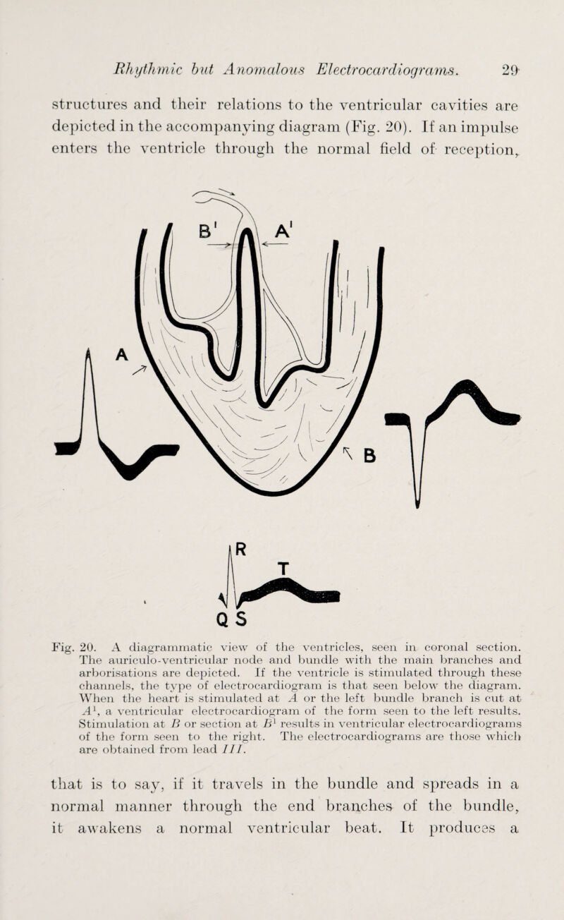 structures and their relations to the ventricular cavities are depicted in the accompanying diagram (Fig. 20). If an impulse enters the ventricle through the normal field of reception. Fig. 20. A diagrammatic view of the ventricles, seen in coronal section. The auriculo-ventricular node and bundle with the main branches and arborisations are depicted. If the ventricle is stimulated through these channels, the type of electrocardiogram is that seen below the diagram. When the heart is stimulated at A or the left bundle branch is cut at A1, a ventricular electrocardiogram of the form seen to the left results. Stimulation at B or section at B1 results in ventricular electrocardiograms of the form seen to the right. The electrocardiograms are those which are obtained from lead III. that is to say, if it travels in the bundle and spreads in a normal manner through the end branches of the bundle, it awakens a normal ventricular beat. It produces a