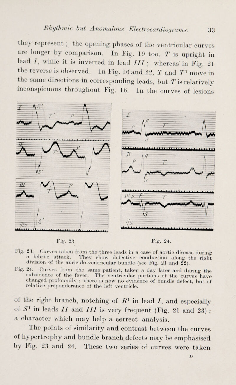 they represent ; the opening phases of the ventricular curves are longer by comparison. In Fig. 19 too, T is upright in lead /, while it is inverted in lead III ; whereas in Fig. 21 the reverse is observed. In Fig. 16 and 22, T and T1 move in the same directions in corresponding leads, but T is relatively inconspicuous throughout F ig. 16. In the curves of lesions Fig. 23. Curves taken from the three leads in a case of aortic disease during a febrile attack. They show defective conduction along the right division of the auriculo-ventricular bundle (see Fig. 21 and 22). tig. 24. Curves from the same patient, taken a day later and during the subsidence of the fever. The ventricular portions of the curves have changed profoundly ; there is now no evidence of bundle defect, but of relative preponderance of the left ventricle. of the right branch, notching of R1 in lead /, and especially of /S'1 in leads II and III is very frequent (Fig. 21 and 23) ; a character which may help a correct analysis. The points of similarity and contrast between the curves of hypertrophy and bundle branch defects may be emphasised by Fig. 23 and 24. These two series of curves were taken D