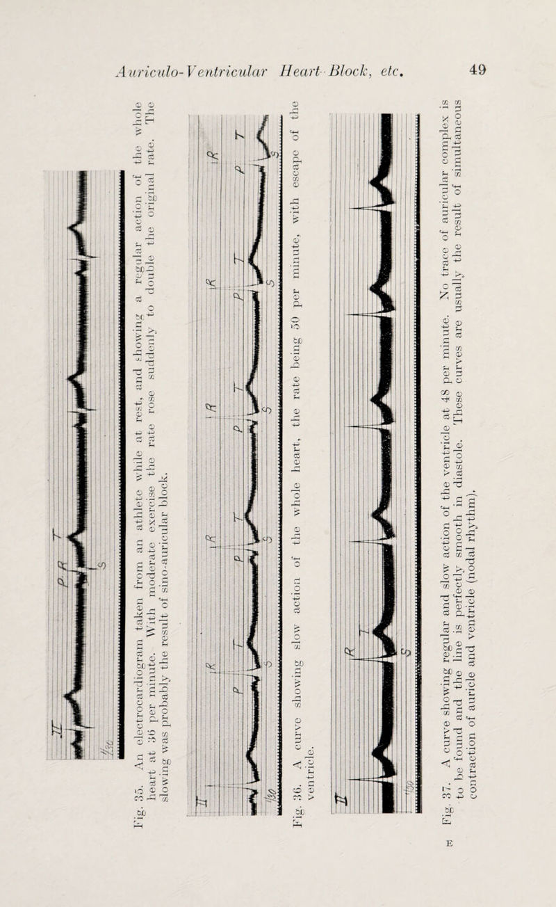 E Fig. 37. A curve showing regular and slow action of the ventricle at 48 per minute. No trace of auricular complex is to be found and the line is perfectly smooth in diastole. These curves are usually the result of simultaneous contraction of auricle and ventricle (nodal rhythm).