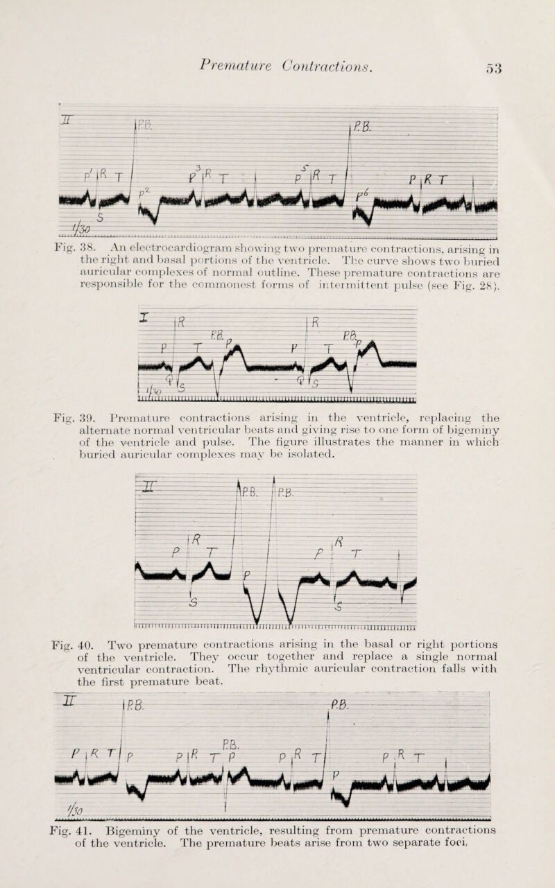 Fig. 38. An electrocardiogram showing two premature contractions, arising in the right and basal portions of the ventricle. The curve shows two buried auricular complexes of normal outline. These premature contractions are responsible for the commonest forms of intermittent pulse (see Fig. 28). Fig. 39. Premature contractions arising in the ventricle, replacing the alternate normal ventricular beats and giving rise to one form of bigeminy of the ventricle and pulse. The figure illustrates the manner in which buried auricular complexes may be isolated. i ip a n r? ir d. | : i-U- rrmrn rrrni rrrrn riri rmmrmntin i nTTifrrm i r t iTTTrrTrrmi i rii jTrnxnTarr Fig. 40. Two premature contractions arising in the basal or right portions of the ventricle. They occur together and replace a single normal ventricular contraction. The rhythmic auricular contraction falls with the first premature beat. Fig. 41. Bigeminy of the ventricle, resulting from premature contractions of the ventricle. The premature beats arise from two separate foci,