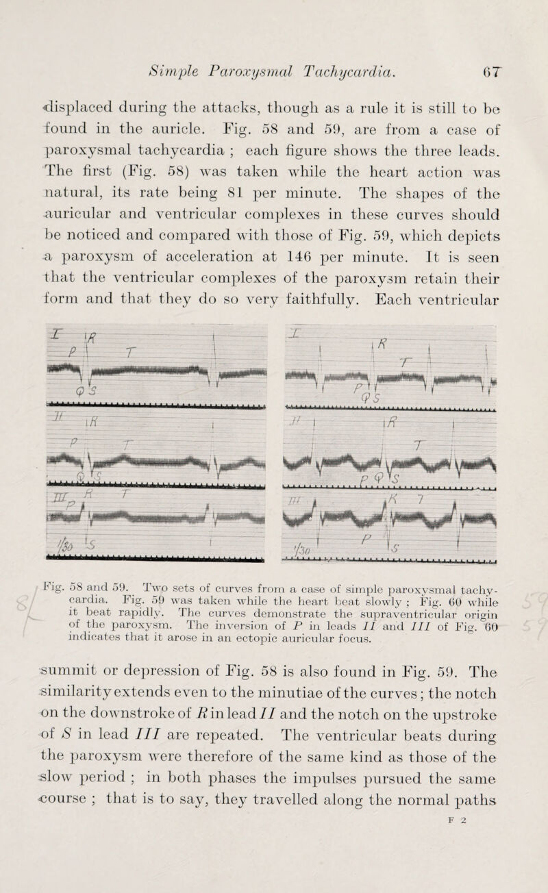 displaced during the attacks, though as a rule it is still to be found in the auricle. Fig. 58 and 59, are from a case of paroxysmal tachycardia ; each figure shows the three leads. The first (Fig. 58) was taken while the heart action was natural, its rate being 81 per minute. The shapes of the •auricular and ventricular complexes in these curves should be noticed and compared with those of Fig. 59, which depicts -a paroxysm of acceleration at 146 per minute. It is seen that the ventricular complexes of the paroxysm retain their form and that they do so very faithfully. Each ventricular 1 ig. 58 and 59. Two sets of curves from a case of simple paroxysmal tachy¬ cardia. Ifi^. 59 was taken while the heart beat slowly ; Fig. 60 while it beat rapidly. The curves demonstrate the supraventricular origin of the paroxysm. The inversion of P in leads II and III of Fig. 60 indicates that it arose in an ectopic auricular focus. summit or depression of Fig. 58 is also found in Fig. 59. The similarity extends even to the minutiae of the curves; the notch on the clownstroke of R in lead// and the notch on the upstroke of S in lead III are repeated. The ventricular beats during the paroxysm were therefore of the same kind as those of the slow period ; in both phases the impulses pursued the same course ; that is to say, they travelled along the normal paths