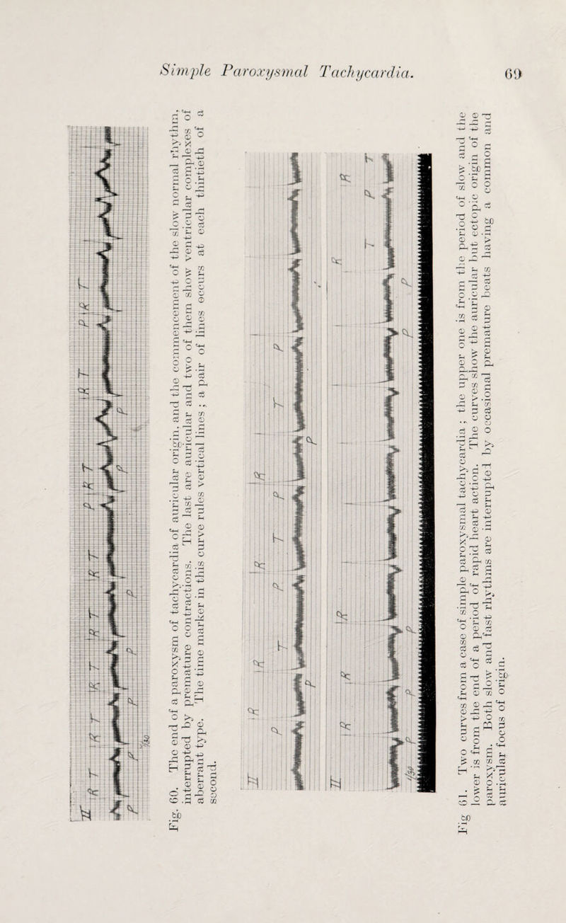 r*rr*r 1? 05 >> y >-i © & ® s*-g o O ri P cS rH p 0 L_ 0 +3 rH P © o3 O -P w ©Mg © H © © © ^ 2 q_, a ° o 5 © © T5 f-H S c3 CU cS cS jg © •rH O tC'r* O P c3 o • >-H © © £ > M © cS H , © © c-4—1 rH k 2h | Co pj O m 0 cS o >v CO rH 1.J ^ --1 O P 0 -A p c3 0 © § Co - -p £ o o a ° M ® t>> 3 * £ c g 3 p r1 c5 3 © o, m /I * O >» . —t 32 © a Pn ST3 >» ^ © -p © -p o C3 ^ r . H p a rs iMr rH £h r . ^ x-S s 1 CX Hx! © c© .3 eg cc cb 61. Two curves from a case of simple paroxysmal tachycardia ; the upper one is from the period of slow and the lower is from the end of a period of rapid heart action. The curves show the auricular but ectopic origin of the paroxysm. Both slow and fast rhythms are interrupted by occasional premature beats having a common and auricular focus of origin.