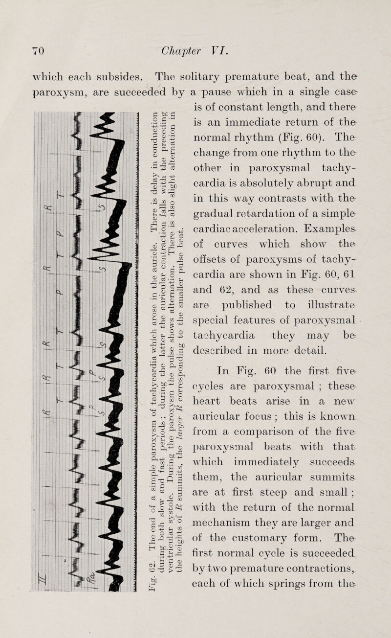 which each paroxysm, subsides. The solitary premature beat, and the are succeeded by a pause which in a single case- is of constant length, and there is an immediate return of the normal rhythm (Fig. 60). The change from one rhythm to the other in paroxysmal tachy¬ cardia is absolutely abrupt and in this way contrasts with the gradual retardation of a simple cardiac acceleration. Examples^ of curves which show the offsets of paroxysms of tachy¬ cardia are shown in Fig. 60, 61 and 62, and as these curves are published to illustrate special features of paroxysmal tachycardia they may be described in more detail. S bJD d o rt --1 ♦ —H • rH -g 'TS £ 2 © O P O'H cd e rj P TO o ^g ° © 1-1 -|P TO ^ rj -P ^ £ rS cd -r bp ■2 » o <D ^ r^H P 4h co CD EH o m •P CD o © © CD g ^ rP2 o -p H © 'p g 4S § 8 • n © jp O p ^ (SPh s -2 g ^ 2 © g © g r±2 02 M ce o „ © £ ® to P3 pq O o o ^ P •d © co © g> p to to o3 3 V T3 © 0-, g p dp! o <£ -p © -Ph o ^ to >i bpp £ JP (H P © 'p 2 o TO P CO O ix] Ph O O mi fr-is-5 ° OP ® a* co .a - © eg £ CO P rj +3 I’Ofil ” 3 . S IS K ® » 'S OpC^ u 1—1 02 ■§ -fro © 2 22 & ^ H bo H bjo.2 © £ p •rH -P ^ • ^ £ © CM 3 © P o > p bio £ In Fig. 60 the first five- cycles are paroxysmal ; these heart beats arise in a new auricular focus ; this is known from a comparison of the five paroxysmal beats with that which immediately succeeds them, the auricular summits are at first steep and small ; with the return of the normal mechanism they are larger and of the customary form. The first normal cycle is succeeded by two premature contractions, each of which springs from the=