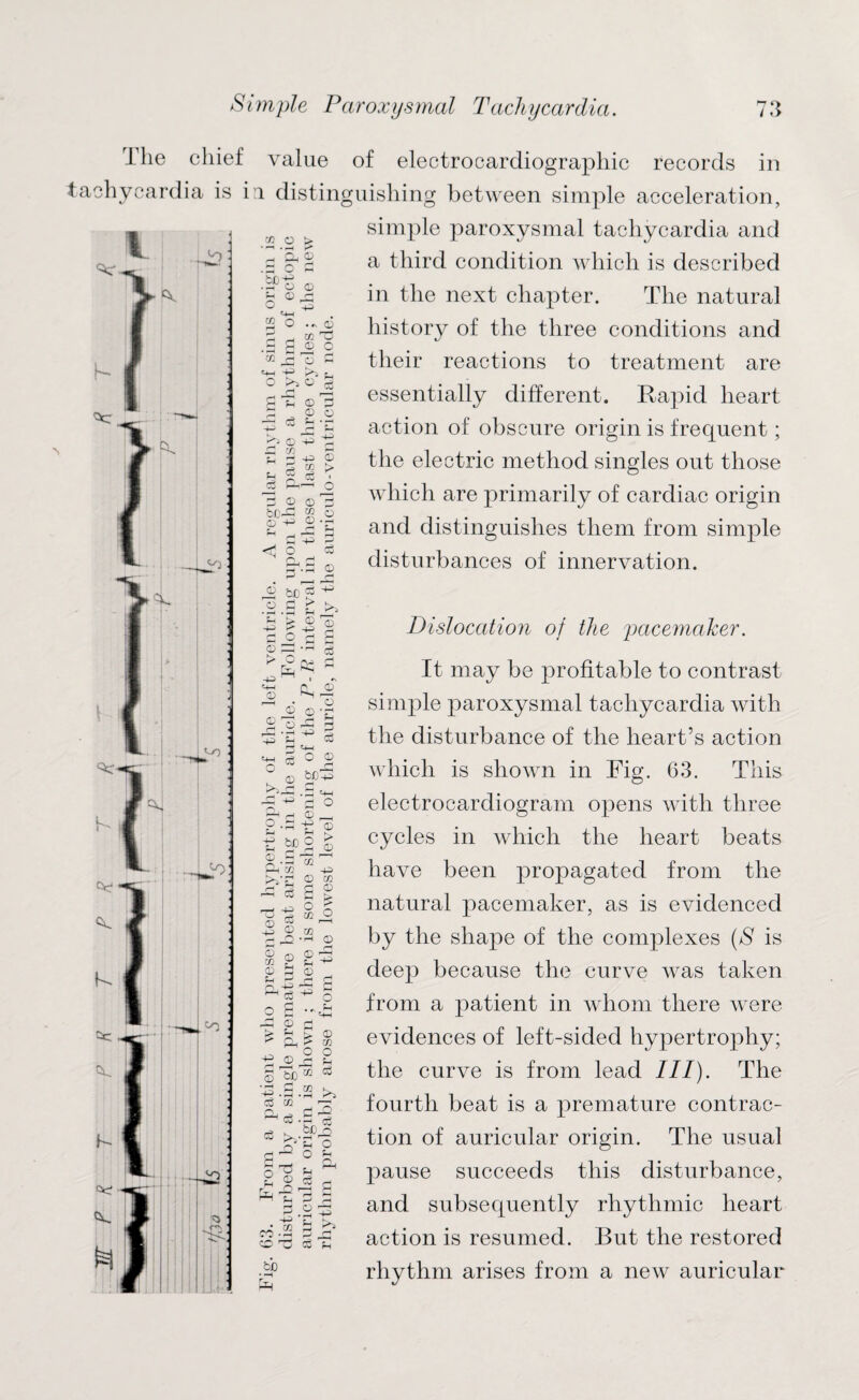 The chief tachycardia is i jo .^o M O > 'rt ’A ® .sort bX)^ .700 Sh © rj O *4-1 2 0..* value of electrocardiographic records in i distinguishing between simple acceleration, simple paroxysmal tachycardia and a third condition which is described in the next chapter. The natural history of the three conditions and their reactions to treatment are essentially different. Rapid heart action of obscure origin is frequent; the electric method singles out those which are primarily of cardiac origin and distinguishes them from simple disturbances of innervation. © P CO Ti © P © O m J3 o p K-a Vi O ^ Cu P Ti © p P © O ^ P V © v -p £  -p © p w > p-i ™ cS 1 o3 CP o p 2 © 3 bC-P “ o a +> © '2 ?H , <—i d , d +3 P <d o p fp.p © © be P 4”1 o p > £ £ S 2 d O g H ^ V s -4V ^ I cx IV ^ o © © © © o H V * £ § u © bJjV P ^ rt o gn ^ © _ P -P ir* © be K» © Q*P Pfi ' ' P-i CD ~P P< p c © 1—1 w C > r O O CD Do r-H -S O OQ — >rH 0 S g J H O >-h -4-i o £ £ s V ®,p 2 © So M ^ 'V.S.2 >> c3 m Qj p P ^ -P ce oc _© o3 P'0 3 O M 2 © cj P.P V .2 p JV ’d Co to Dislocation of the pacemaker. It may be profitable to contrast simple paroxysmal tachycardia with the disturbance of the heart’s action which is shown in Fig. 63. This electrocardiogram opens with three cycles in which the heart beats have been propagated from the natural pacemaker, as is evidenced by the shape of the complexes (S is deep because the curve was taken from a patient in whom there were evidences of left-sided hypertrophy; the curve is from lead III). The fourth beat is a premature contrac¬ tion of auricular origin. The usual pause succeeds this disturbance, and subsequently rhythmic heart action is resumed. But the restored rhythm arises from a new auricular