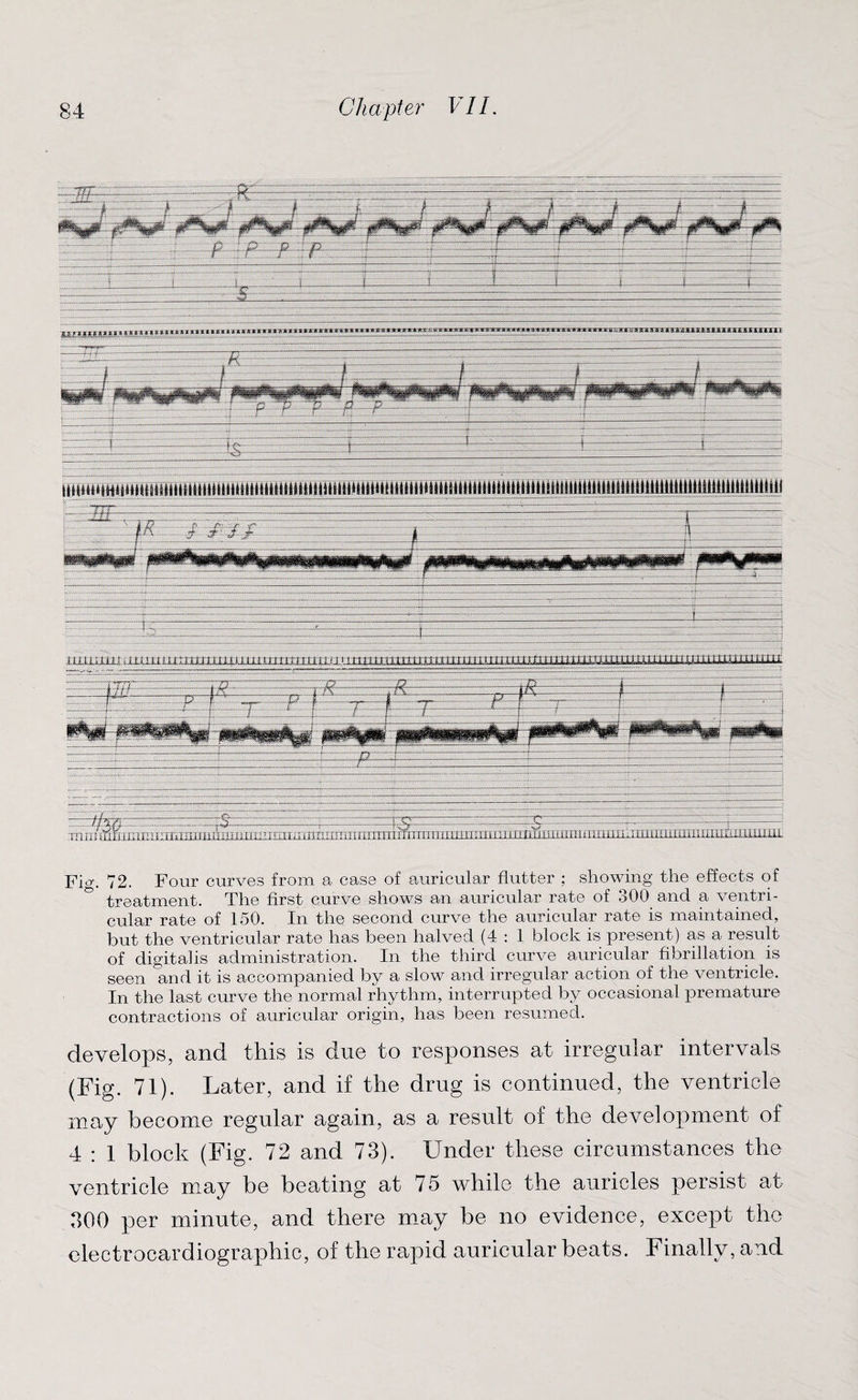 Fig. 72. Four curves from a case of auricular flutter ; showing the effects of ° treatment. The first curve shows an auricular rate of 300 and a ventri¬ cular rate of 150. In the second curve the auricular rate is maintained, but the ventricular rate has been halved (4 : 1 block is present) as a result of digitalis administration. In the third curve auricular fibrillation is seen and it is accompanied by a slow and irregular action of the ventricle. In the last curve the normal rhythm, interrupted by occasional premature contractions of auricular origin, has been resumed. develops, and this is due to responses at irregular intervals (Fig. 71). Later, and if the drug is continued, the ventricle may become regular again, as a result of the development of 4 : 1 block (Fig. 72 and 73). Under these circumstances the ventricle may be beating at 75 while the auricles persist at 300 per minute, and there may be no evidence, except the electrocardiographic, of the rapid auricular beats. Finally, and . h3d ..r3-