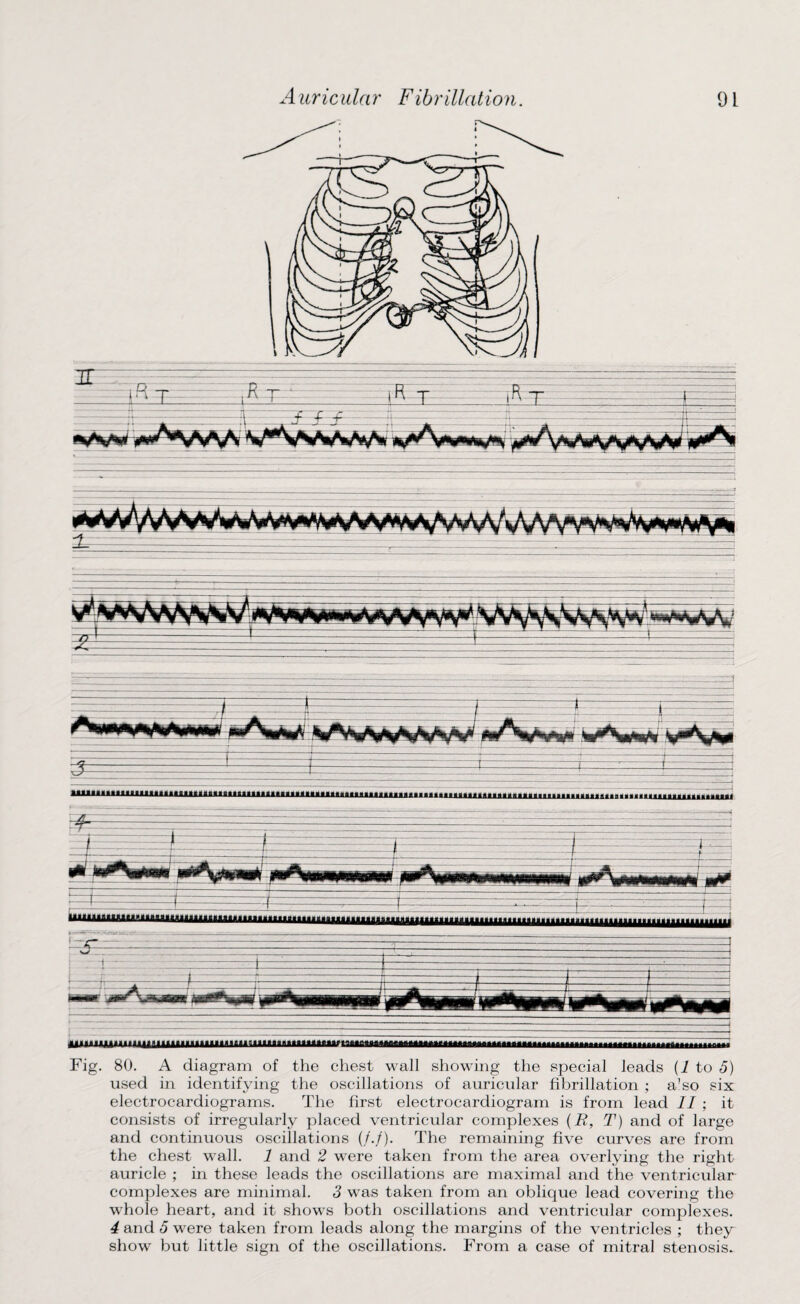 Fig. 80. A diagram of the chest wall showing the special leads (1 to 5) used in identifying the oscillations of auricular fibrillation ; a’so six electrocardiograms. The first electrocardiogram is from lead II ; it consists of irregularly placed ventricular complexes (B, T) and of large and continuous oscillations (/./). The remaining five curves are from the chest wall. 1 and 2 were taken from the area overlying the right auricle ; in these leads the oscillations are maximal and the ventricular complexes are minimal. 3 was taken from an oblique lead covering the whole heart, and it shows both oscillations and ventricular complexes. 4 and 5 were taken from leads along the margins of the ventricles ; they show but little sign of the oscillations. From a case of mitral stenosis.