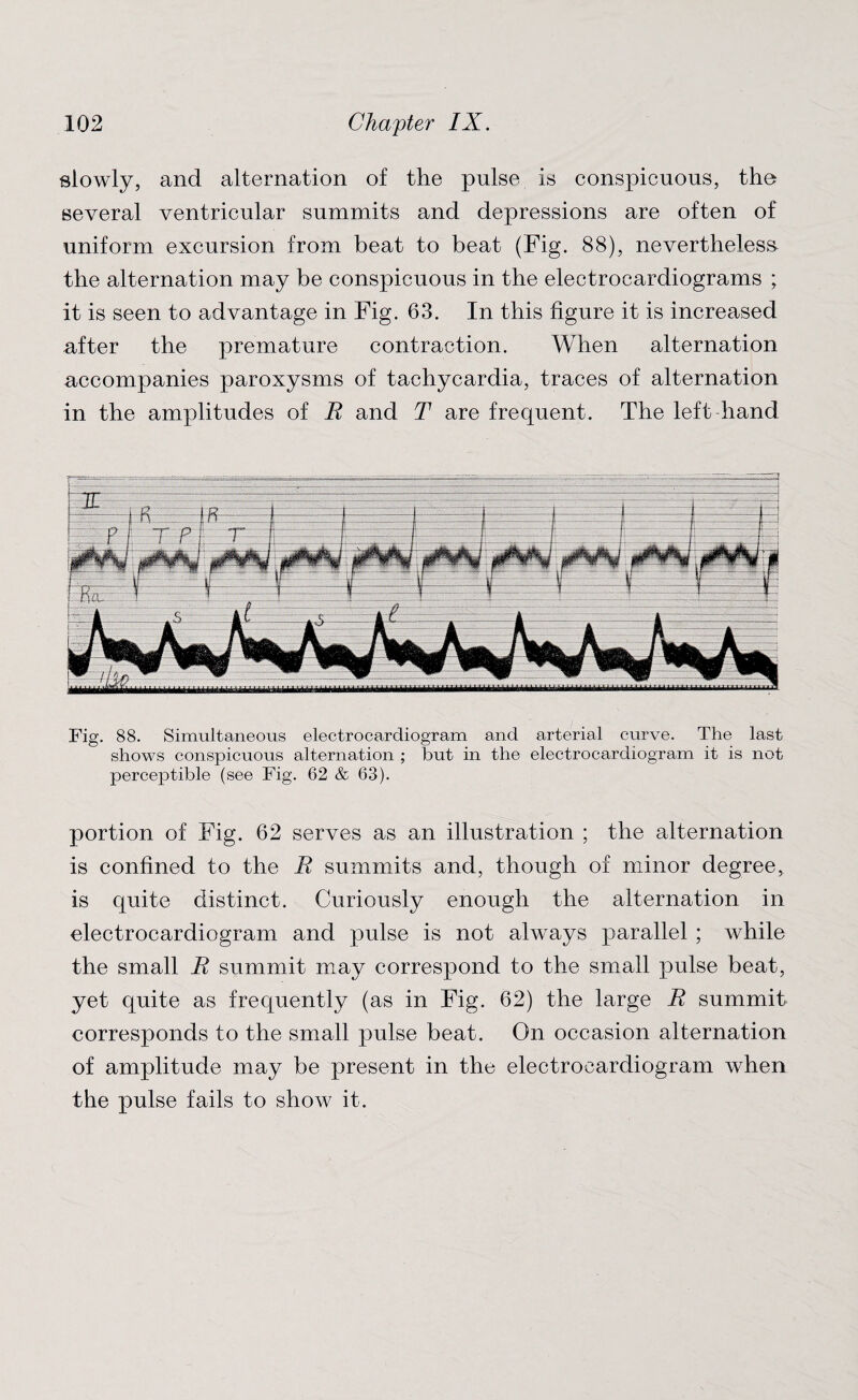 slowly, and alternation of the pulse is conspicuous, the several ventricular summits and depressions are often of uniform excursion from beat to beat (Fig. 88), nevertheless- the alternation may be conspicuous in the electrocardiograms ; it is seen to advantage in Fig. 63. In this figure it is increased after the premature contraction. When alternation accompanies paroxysms of tachycardia, traces of alternation in the amplitudes of E and T are frequent. The left hand Fig. 88. Simultaneous electrocardiogram and arterial curve. The last shows conspicuous alternation ; but in the electrocardiogram it is not perceptible (see Fig. 62 & 63). portion of Fig. 62 serves as an illustration ; the alternation is confined to the R summits and, though of minor degree, is quite distinct. Curiously enough the alternation in electrocardiogram and pulse is not always parallel ; while the small R summit may correspond to the small pulse beat, yet quite as frequently (as in Fig. 62) the large R summit corresponds to the small pulse beat. On occasion alternation of amplitude may be present in the electrocardiogram when the pulse fails to show it.