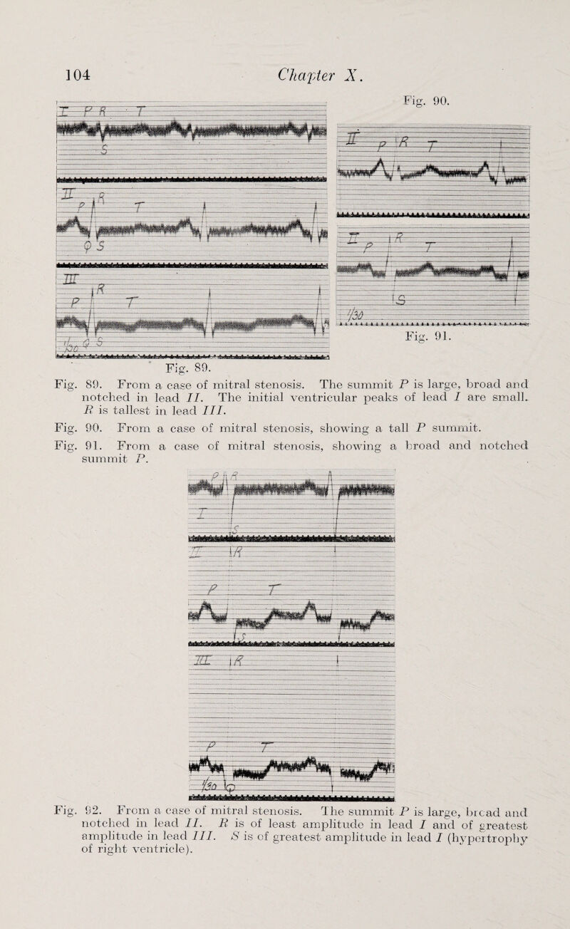 Fig. 90. Fig. 89. Fig. 89. From a case of mitral stenosis. The summit P is large, broad and notched in lead II. The initial ventricular peaks of lead I are smalh B is tallest in lead III. Fig. 90. From a case of mitral stenosis, showing a tall P summit. Fig. 91. From a case of mitral stenosis, showing a broad and notched summit P. 1 Mjf . ..r~— tf..— -4.—. \...—....... .. :~p... -.. ... •ij....... ..- ivr......... ... --■■■... ....JjjM, ^ .::— — f ■•■■t1 .1.L_ . po .- . -.:.4 .. Fig. 92. From a case of mitral stenosis. The summit P is large, bread and notched in lead II. B is of least amplitude in lead I and of greatest amplitude in lead III. S is of greatest amplitude in lead I (hypertrophy of right ventricle).