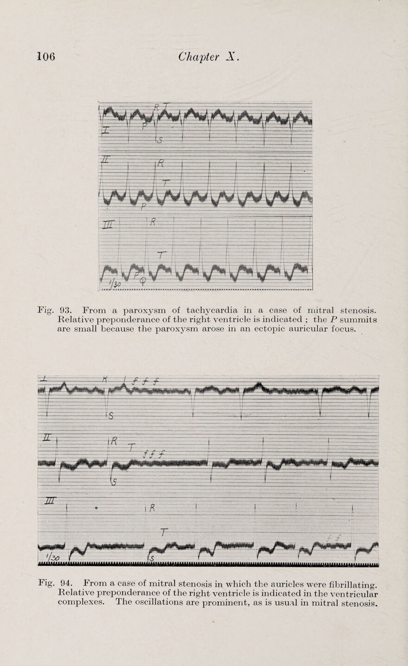 Fig. 93. From a paroxysm of tachycardia in a case of mitral stenosis. Relative preponderance of the right ventricle is indicated ; the P summits are small because the paroxysm arose in an ectopic auricular focus. Fig. 94. From a case of mitral stenosis in which the auricles were fibrillating. Relative preponderance of the right ventricle is indicated in the ventricular complexes. The oscillations are prominent, as is usual in mitral stenosis.