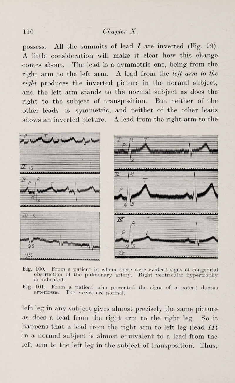 possess. All the summits of lead I are inverted (Fig. 99). A little consideration will make it clear how this change comes about. The lead is a symmetric one, being from the right arm to the left arm. A lead from the left arm to the right produces the inverted picture in the normal subject, and the left arm stands to the normal subject as does the right to the subject of transposition. But neither of the other leads is symmetric, and neither of the other leads shows an inverted picture. A lead from the right arm to the Fig. 100. From a patient in whom there were evident signs of congenital obstruction of the pulmonary artery. Right ventricular hypertrophy is indicated. Fig. 101.. From a patient who presented the signs of a patent ductus arteriosus. The curves are normal. left leg in any subject gives almost precisely the same picture as does a lead from the right arm to the right leg. So it happens that a lead from the right arm to left leg (lead II) in a normal subject is almost equivalent to a lead from the left arm to the left leg in the subject of transposition. Thus,