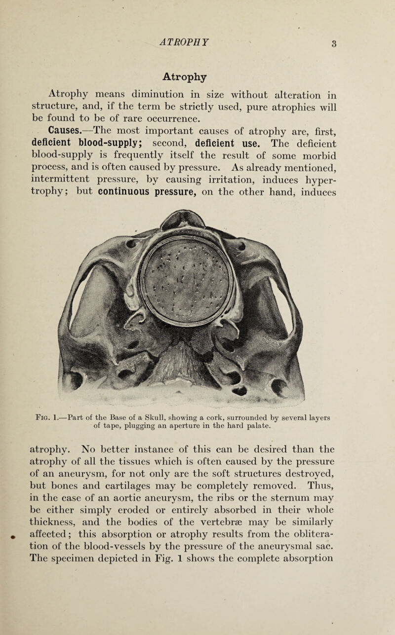 ATROPHY Atrophy Atrophy means diminution in size without alteration in structure, and, if the term be strictly used, pure atrophies will be found to be of rare occurrence. Causes.—The most important causes of atrophy are, first, deficient blood-supply; second, deficient use. The deficient blood-supply is frequently itself the result of some morbid process, and is often caused by pressure. As already mentioned, intermittent pressure, by causing irritation, induces hyper¬ trophy; but continuous pressure, on the other hand, induces Fig. 1.—Part of the Base of a Skull, showing a cork, surrounded by several layers of tape, plugging an aperture in the hard palate. atrophy. No better instance of this can be desired than the atrophy of all the tissues which is often caused by the pressure of an aneurysm, for not only are the soft structures destroyed, but bones and cartilages may be completely removed. Thus, in the case of an aortic aneurysm, the ribs or the sternum may be either simply eroded or entirely absorbed in their whole thickness, and the bodies of the vertebrae may be similarly affected; this absorption or atrophy results from the oblitera¬ tion of the blood-vessels by the pressure of the aneurysmal sac. The specimen depicted in Fig. 1 shows the complete absorption