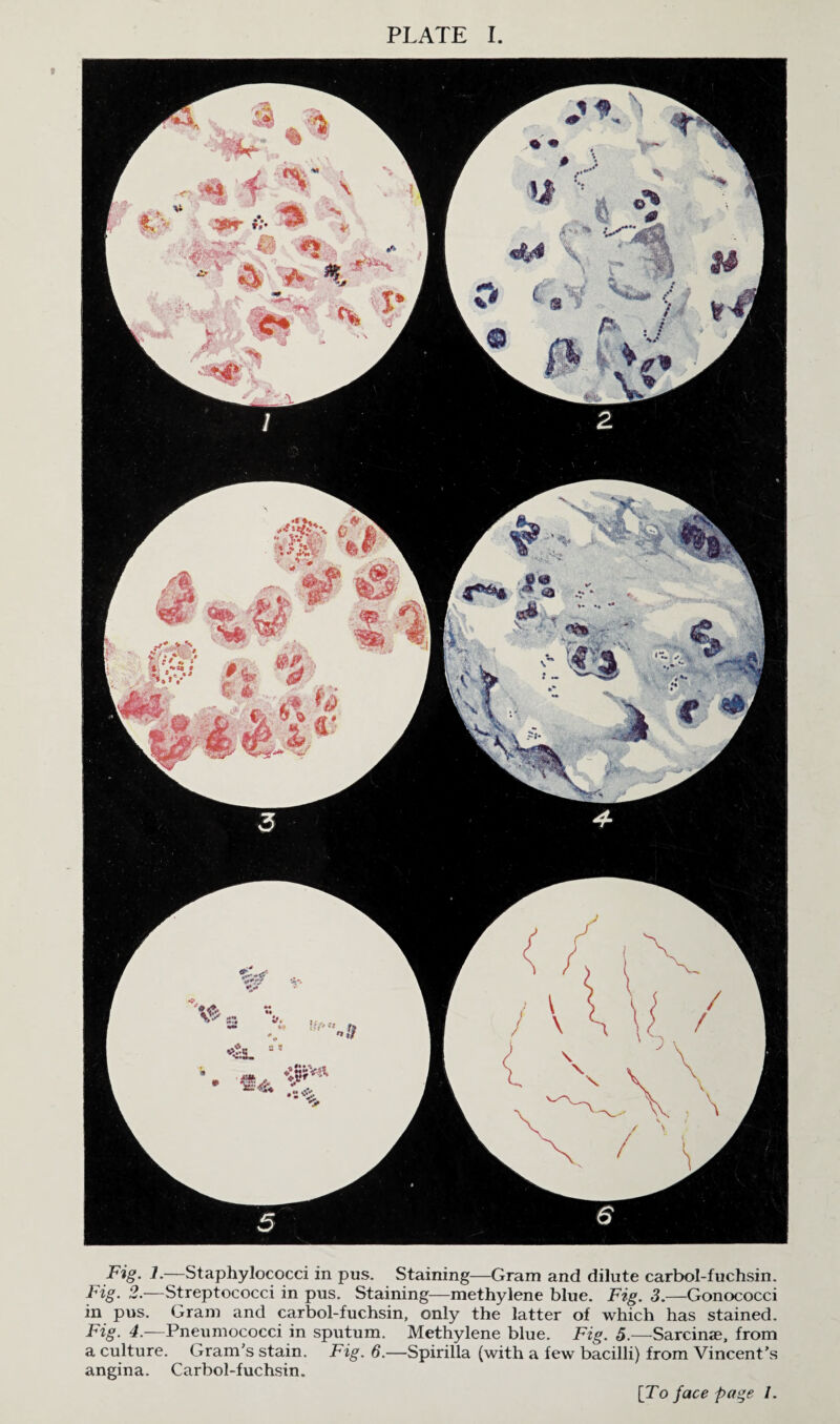 PLATE I. Fig. 1.—Staphylococci in pus. Staining—Gram and dilute carbol-fuchsin. Fig. 2.—Streptococci in pus. Staining—methylene blue. Fig. 3.—Gonococci in pus. Gram and carbol-fuchsin, only the latter of which has stained. Fig. 4.—Pneumococci in sputum. Methylene blue. Fig. 5.—Sarcinae, from a culture. Gram's stain. Fig. 6.—Spirilla (with a few bacilli) from Vincent’s angina. Carbol-fuchsin. [To face page 1.