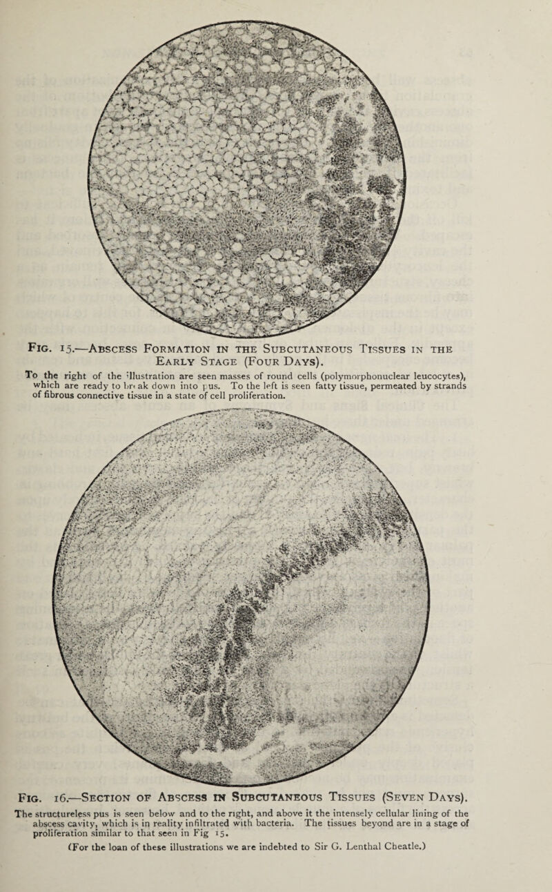 Fig. 15.—Abscess Formation in the Subcutaneous Tissues in the Early Stage (Four Days). To the right of the illustration are seen masses of round cells (polymorphonuclear leucocytes), which are ready to bn ak down into pus. To the left is seen fatty tissue, permeated by strands of fibrous connective tissue in a state of cell proliferation. Fig. 16.—Section of Abscess in Subcutaneous Tissues (Seven Days). The structureless pus is seen below and to the right, and above it the intensely cellular lining of the abscess cavity, which is in reality infiltrated with bacteria. The tissues beyond are in a stage of proliferation similar to that seen in Fig 15. (For the loan of these illustrations we are indebted to Sir G. Lenthal Cheatle.)