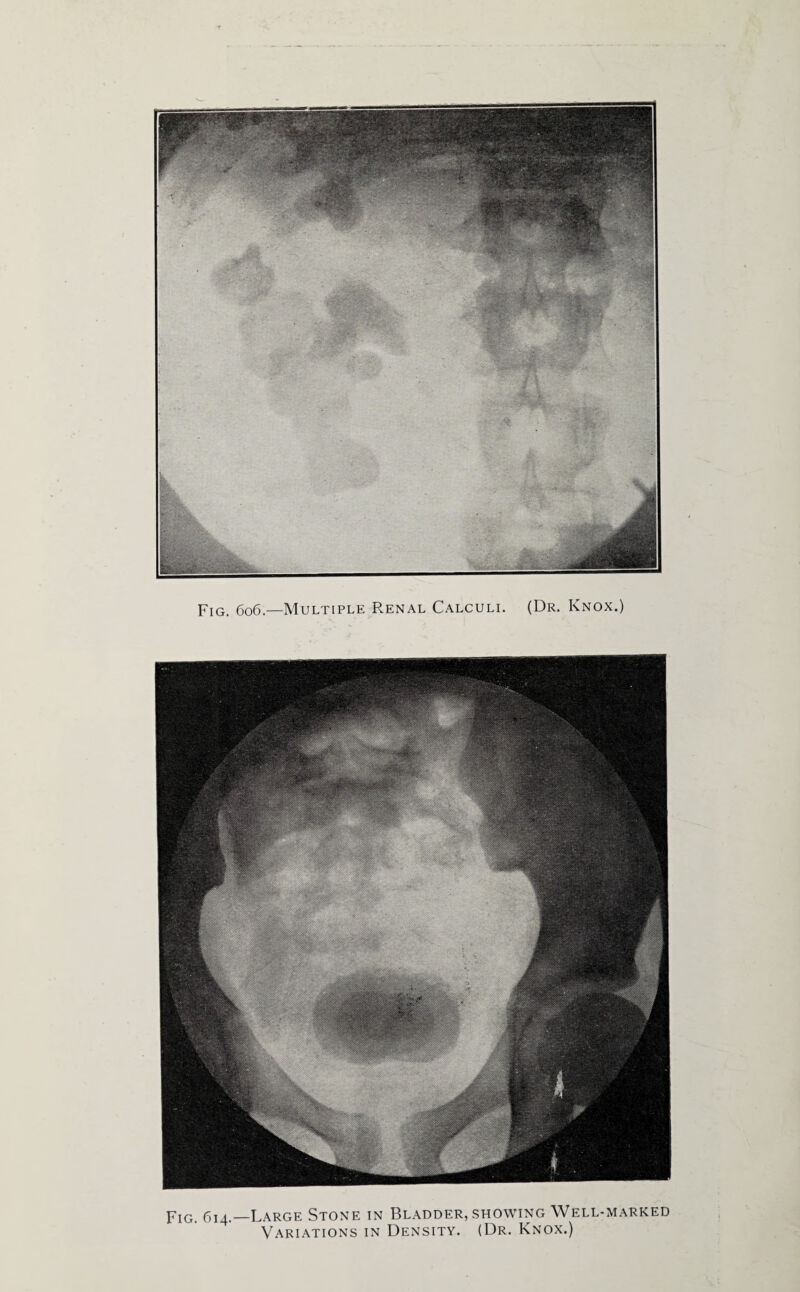 Fig. 606—Multiple Renal Calculi. (Dr. Knox.) Fig. 614.—Large Stone in Bladder, showing Well-marked Variations in Density. (Dr. Knox.)