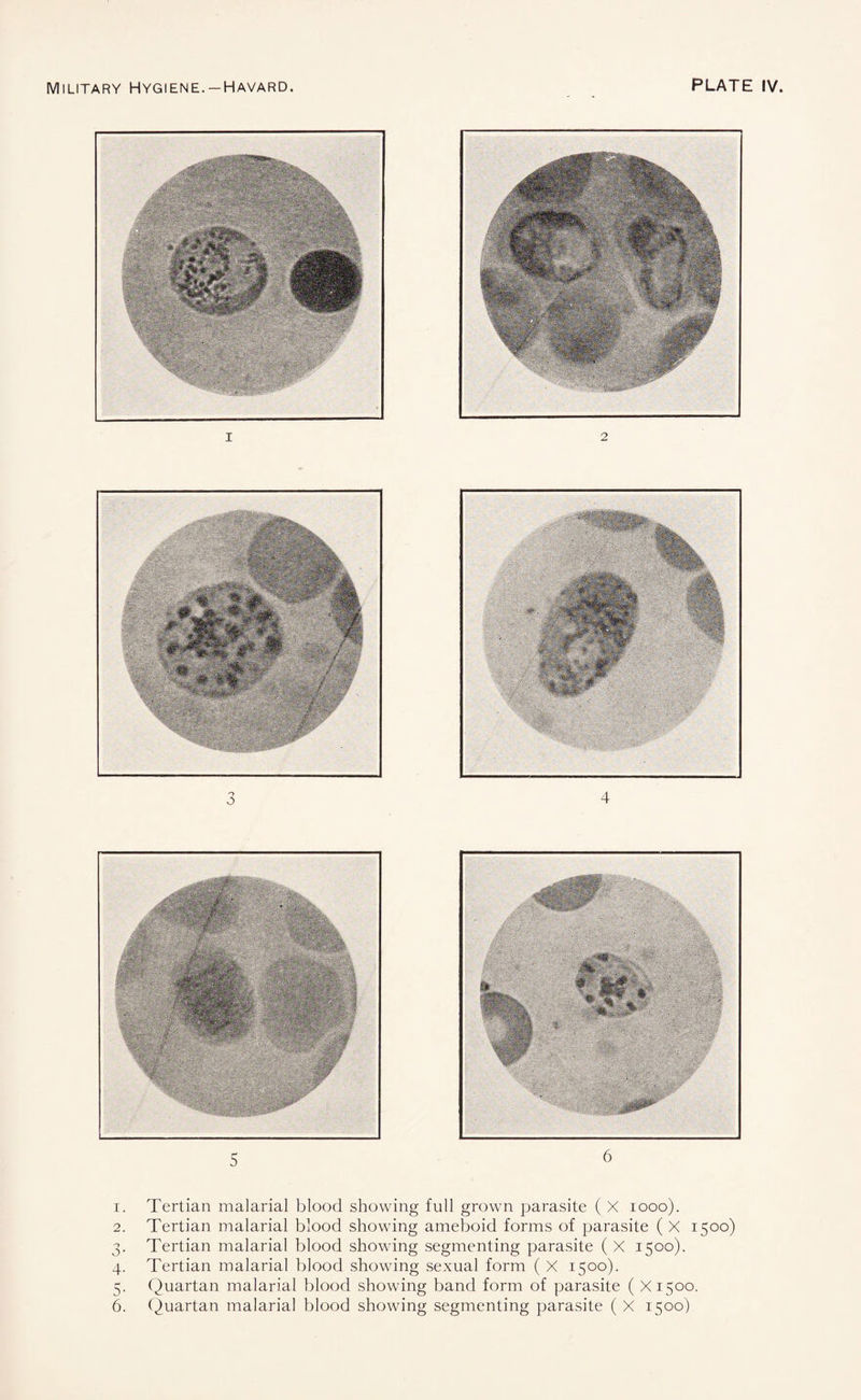 1. Tertian malarial blood showing full grown parasite ( X 1000). 2. Tertian malarial blood showing ameboid forms of parasite ( X 1500) 3. Tertian malarial blood showing segmenting parasite ( X 1500). 4. Tertian malarial blood showing sexual form ( X 1500). 5. Quartan malarial blood showing band form of parasite ( X1500.