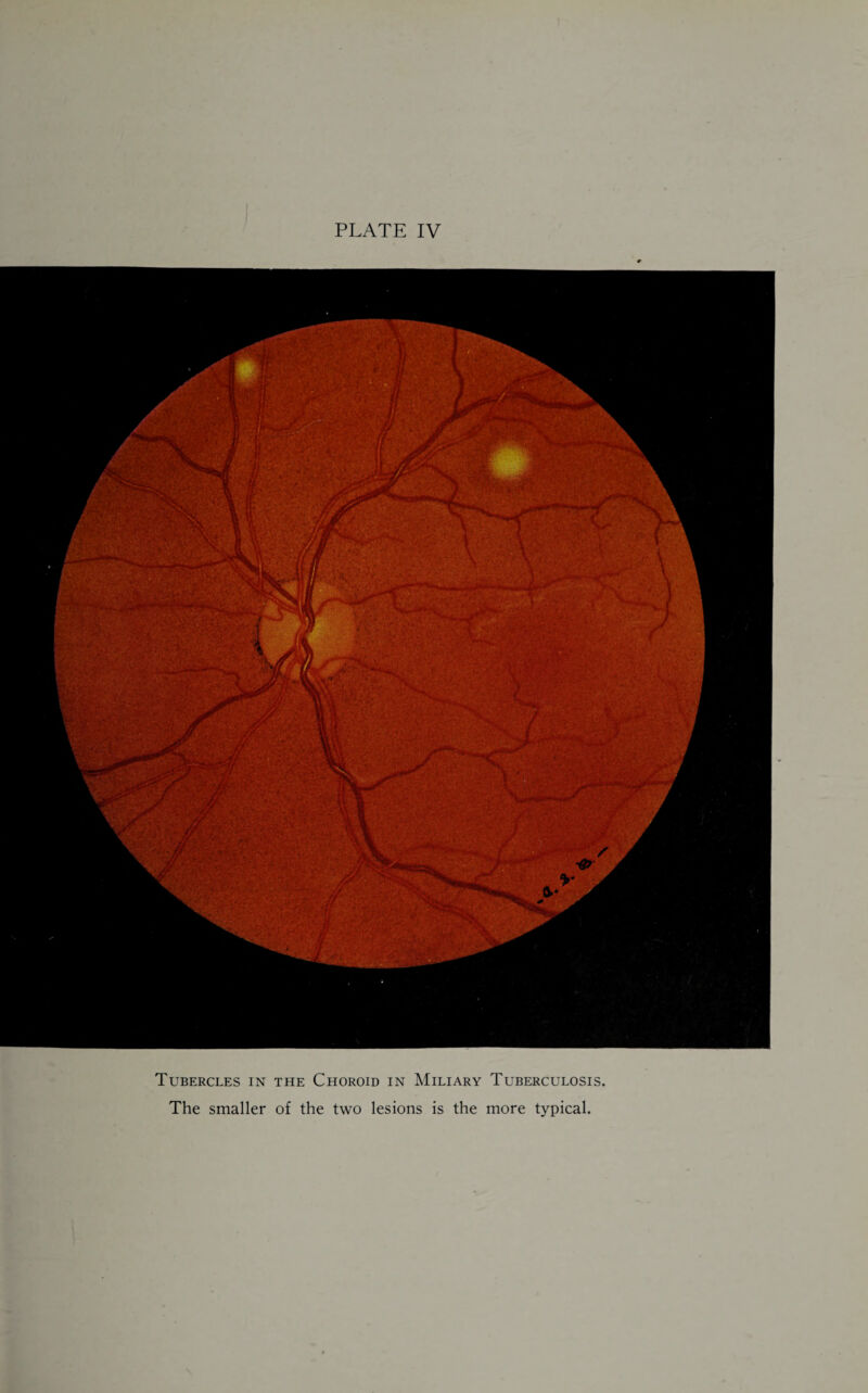 PLATE IV Tubercles in the Choroid in Miliary Tuberculosis The smaller of the two lesions is the more typical.