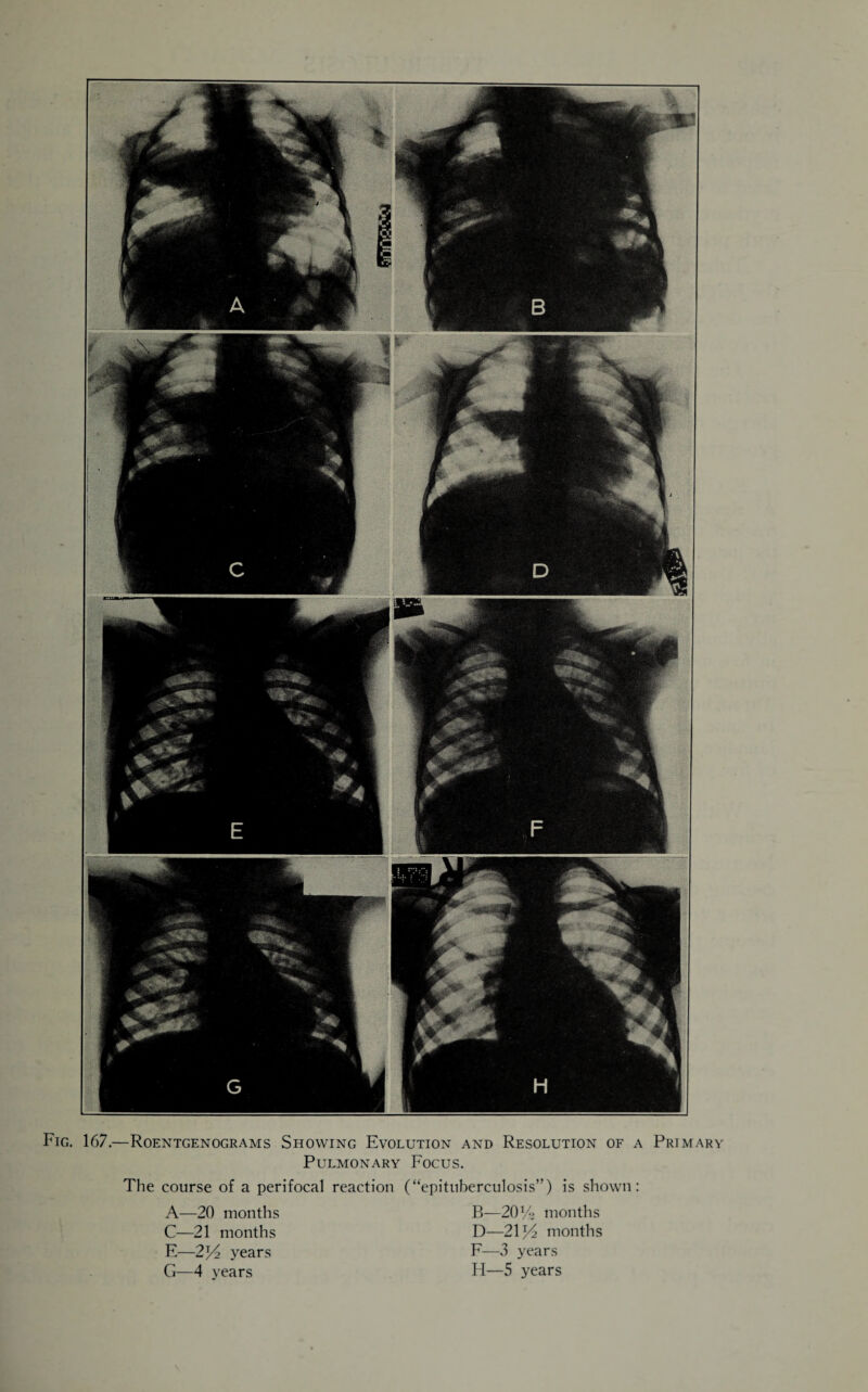 Fig. 167.—Roentgenograms Showing Evolution and Resolution of a Primary Pulmonary Focus. The course of a perifocal reaction (“epituberculosis”) is shown: A—20 months C—21 months E—2% years G—4 years B—20% months D—21% months F—3 years H—5 years