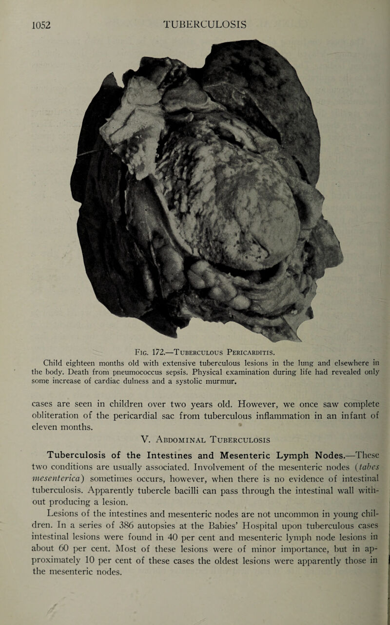 Fig. 172.—Tuberculous Pericarditis. Child eighteen months old with extensive tuberculous lesions in the lung and elsewhere in the body. Death from pneumococcus sepsis. Physical examination during life had revealed only some increase of cardiac dulness and a systolic murmur. cases are seen in children over two years old. However, we once saw complete obliteration of the pericardial sac from tuberculous inflammation in an infant of eleven months. V. Abdominal Tuberculosis Tuberculosis of the Intestines and Mesenteric Lymph Nodes.—These two conditions are usually associated. Involvement of the mesenteric nodes (tabes mesenterica) sometimes occurs, however, when there is no evidence of intestinal tuberculosis. Apparently tubercle bacilli can pass through the intestinal wall with¬ out producing a lesion. Lesions of the intestines and mesenteric nodes are not uncommon in young chil¬ dren. In a series of 386 autopsies at the Babies’ Hospital upon tuberculous cases intestinal lesions were found in 40 per cent and mesenteric lymph node lesions in about 60 per cent. Most of these lesions were of minor importance, but in ap¬ proximately 10 per cent of these cases the oldest lesions were apparently those in the mesenteric nodes.