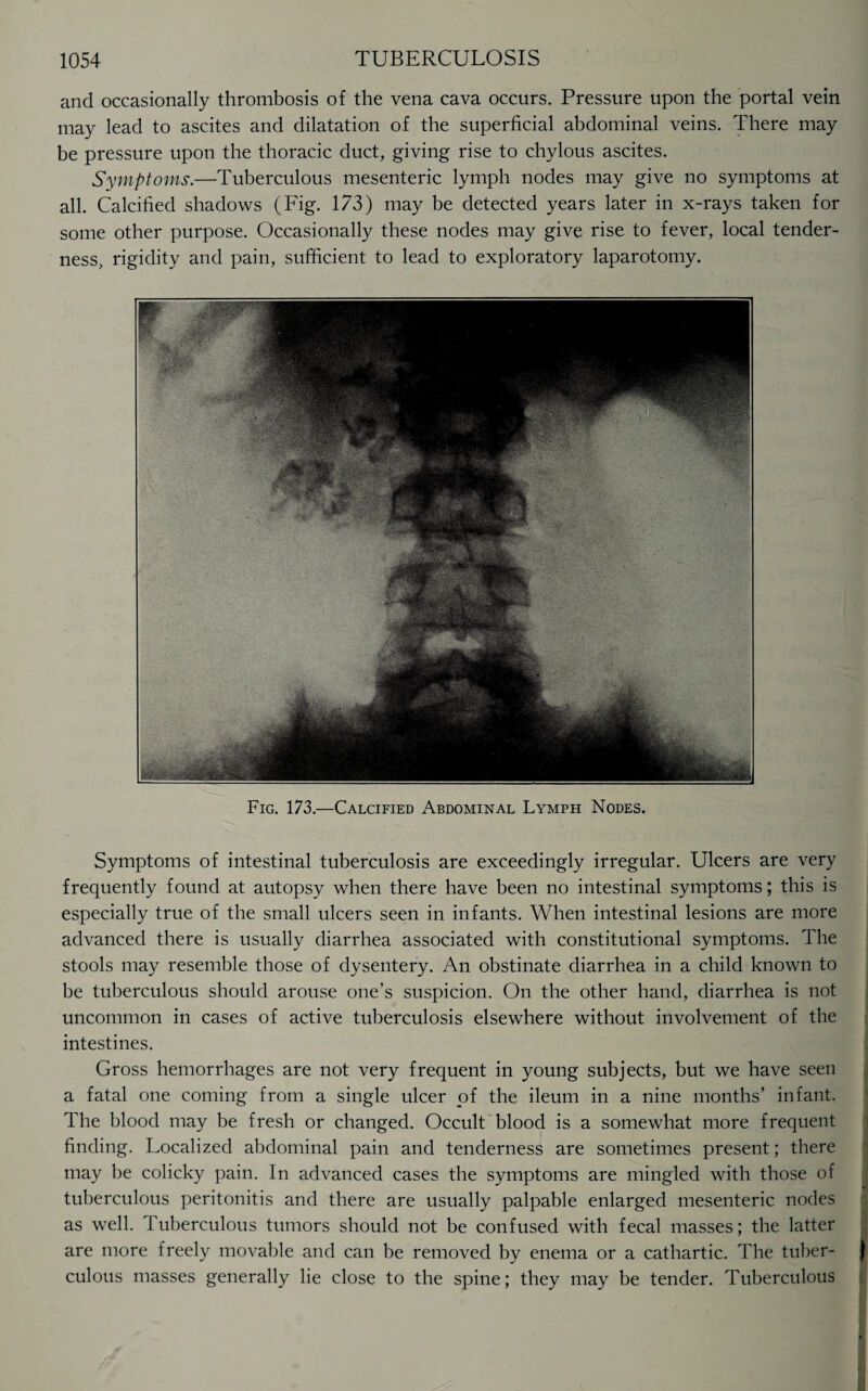 and occasionally thrombosis of the vena cava occurs. Pressure upon the portal vein may lead to ascites and dilatation of the superficial abdominal veins. There may be pressure upon the thoracic duct, giving rise to chylous ascites. Symptoms.—Tuberculous mesenteric lymph nodes may give no symptoms at all. Calcified shadows (Fig. 173) may be detected years later in x-rays taken for some other purpose. Occasionally these nodes may give rise to fever, local tender¬ ness, rigidity and pain, sufficient to lead to exploratory laparotomy. Fig. 173.—Calcified Abdominal Lymph Nodes. Symptoms of intestinal tuberculosis are exceedingly irregular. Ulcers are very frequently found at autopsy when there have been no intestinal symptoms; this is especially true of the small ulcers seen in infants. When intestinal lesions are more advanced there is usually diarrhea associated with constitutional symptoms. The stools may resemble those of dysentery. An obstinate diarrhea in a child known to be tuberculous should arouse one’s suspicion. On the other hand, diarrhea is not uncommon in cases of active tuberculosis elsewhere without involvement of the intestines. Gross hemorrhages are not very frequent in young subjects, but we have seen a fatal one coming from a single ulcer of the ileum in a nine months’ infant. The blood may be fresh or changed. Occult blood is a somewhat more frequent finding. Localized abdominal pain and tenderness are sometimes present; there may be colicky pain. In advanced cases the symptoms are mingled with those of tuberculous peritonitis and there are usually palpable enlarged mesenteric nodes as well. 1 uberculous tumors should not be confused with fecal masses; the latter are more freely movable and can be removed by enema or a cathartic. The tuber- $ culous masses generally lie close to the spine; they may be tender. Tuberculous