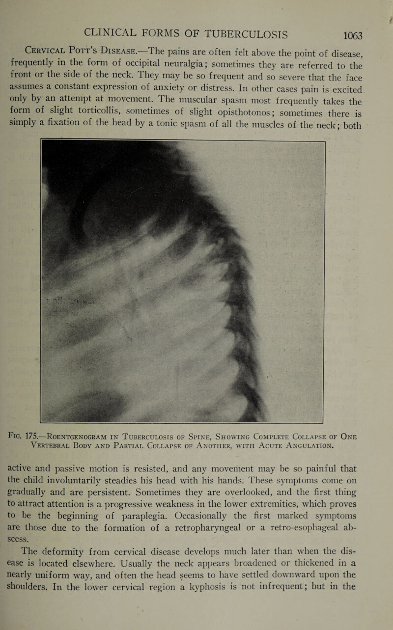 Cervical Pott s Disease. The pains are often felt above the point of disease, frequently in the form of occipital neuralgia ; sometimes they are referred to the front or the side of the neck. They may be so frequent and so severe that the face assumes a constant expiession of anxiety or distress. In other cases pam is excited only by an attempt at movement. The muscular spasm most frequently takes the form of slight torticollis, sometimes of slight opisthotonos; sometimes there is simply a fixation of the head by a tonic spasm of all the muscles of the neck; both Fig. 175.—Roentgenogram in Tuberculosis of Spine, Showing Complete Collapse of One Vertebral Body and Partial Collapse of Another, with Acute Angulation. active and passive motion is resisted, and any movement may be so painful that the child involuntarily steadies his head with his hands. These symptoms come on gradually and are persistent. Sometimes they are overlooked, and the first thing to attract attention is a progressive weakness in the lower extremities, which proves to be the beginning of paraplegia. Occasionally the first marked symptoms are those due to the formation of a retropharyngeal or a retro-esophageal ab¬ scess. The deformity from cervical disease develops much later than when the dis¬ ease is located elsewhere. Usually the neck appears broadened or thickened in a nearly uniform way, and often the head seems to have settled downward upon the shoulders. In the lower cervical region a kyphosis is not infrequent; but in the