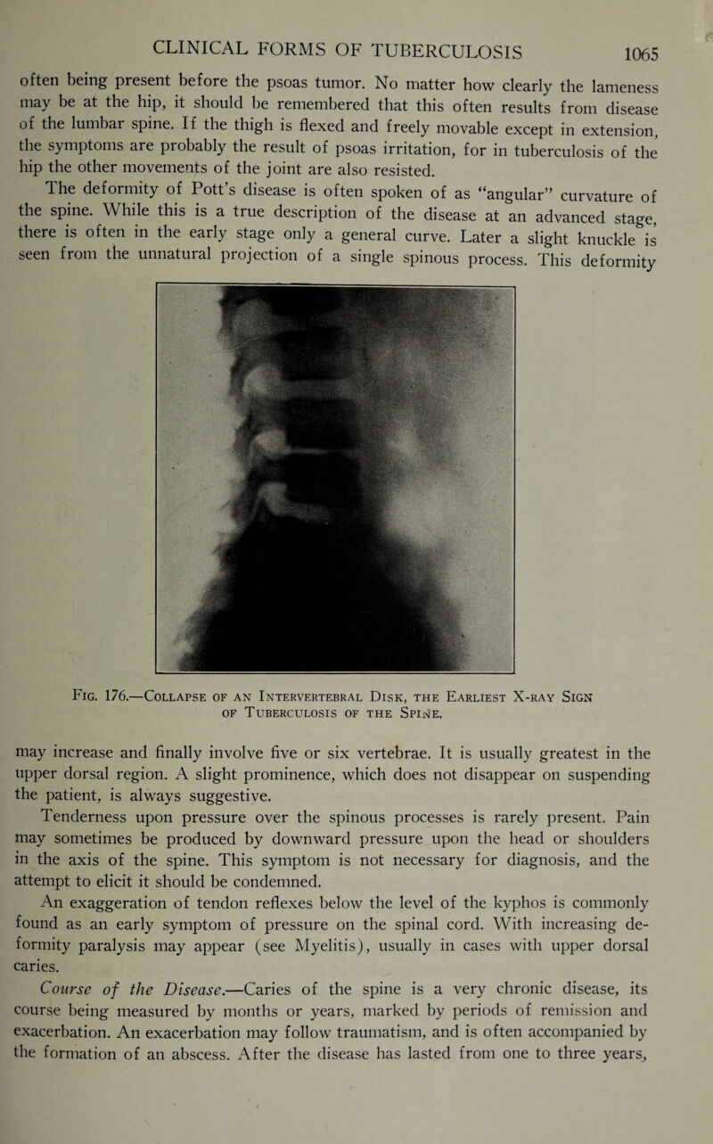 often being present before the psons tumor. No instter how clenrly the lsmeness may be at the hip, it should be remembered that this often results from disease of the lumbar spine. If the thigh is flexed and freely movable except in extension the symptoms are probably the result of psoas irritation, for in tuberculosis of the hip the other movements of the joint are also resisted. The deformity of Pott’s disease is often spoken of as “angular” curvature of the spine. While this is a true description of the disease at an advanced stage, there is often in the early stage only a general curve. Later a slight knuckle is seen from the unnatural projection of a single spinous process. This deformity Fig. 176.—Collapse of an Intervertebral Disk, the Earliest X-ray Sign of Tuberculosis of the Spine. may increase and finally involve five or six vertebrae. It is usually greatest in the upper dorsal region. A slight prominence, which does not disappear on suspending the patient, is always suggestive. Tenderness upon pressure over the spinous processes is rarely present. Pain may sometimes be produced by downward pressure upon the head or shoulders in the axis of the spine. This symptom is not necessary for diagnosis, and the attempt to elicit it should be condemned. An exaggeration of tendon reflexes below the level of the kyphos is commonly found as an early symptom of pressure on the spinal cord. With increasing de¬ formity paralysis may appear (see Myelitis), usually in cases with upper dorsal caries. Course of the Disease.—Caries of the spine is a very chronic disease, its course being measured by months or years, marked by periods of remission and exacerbation. An exacerbation may follow traumatism, and is often accompanied by the formation of an abscess. After the disease has lasted from one to three years.