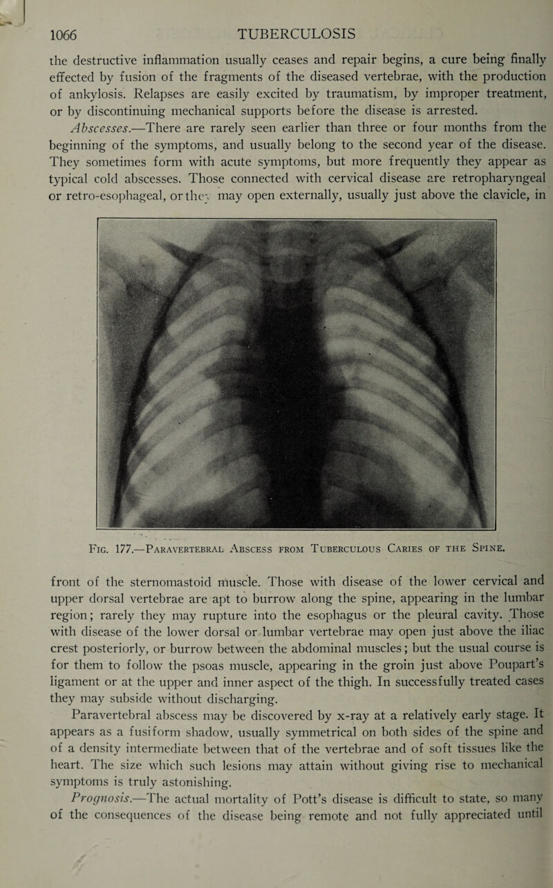 the destructive inflammation usually ceases and repair begins, a cure being finally effected by fusion of the fragments of the diseased vertebrae, with the production of ankylosis. Relapses are easily excited by traumatism, by improper treatment, or by discontinuing mechanical supports before the disease is arrested. Abscesses.—There are rarely seen earlier than three or four months from the beginning of the symptoms, and usually belong to the second year of the disease. They sometimes form with acute symptoms, but more frequently they appear as typical cold abscesses. Those connected with cervical disease are retropharyngeal or retro-esophageal, or they may open externally, usually just above the clavicle, in Fig. 177.—Paravertebral Abscess from Tuberculous Caries of the Spine. front of the sternomastoicl muscle. Those with disease of the lower cervical and upper dorsal vertebrae are apt to burrow along the spine, appearing in the lumbar region; rarely they may rupture into the esophagus or the pleural cavity. Those with disease of the lower dorsal or lumbar vertebrae may open just above the iliac crest posteriorly, or burrow between the abdominal muscles; but the usual course is for them to follow the psoas muscle, appearing in the groin just above Poupart’s ligament or at the upper and inner aspect of the thigh. In successfully treated cases they may subside without discharging. Paravertebral abscess may be discovered by x-ray at a relatively early stage. It appears as a fusiform shadow, usually symmetrical on both sides of the spine and of a density intermediate between that of the vertebrae and of soft tissues like the heart. T he size which such lesions may attain without giving rise to mechanical symptoms is truly astonishing. Prognosis.—The actual mortality of Pott’s disease is difficult to state, so many of the consequences of the disease being remote and not fully appreciated until