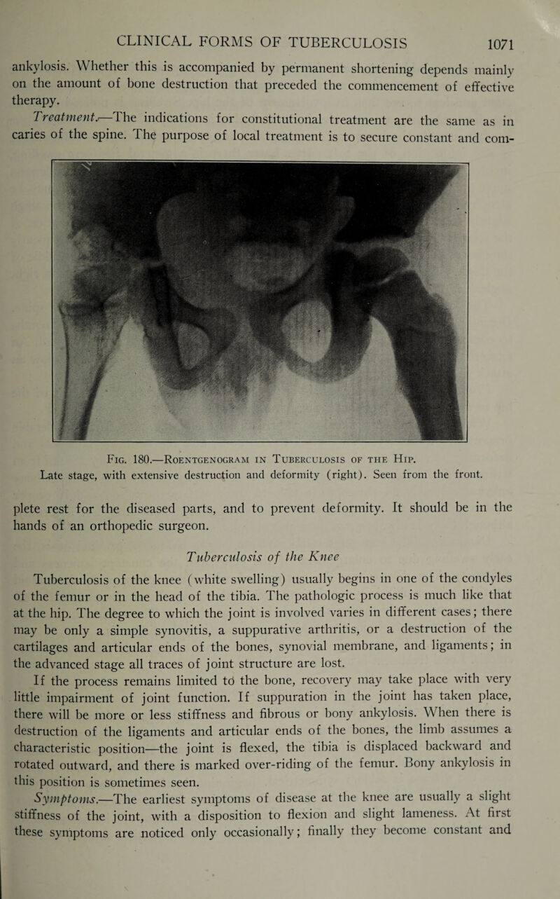 ankylosis. Whether this is accompanied by permanent shortening depends mainly on the amount of bone destruction that preceded the commencement of effective therapy. Treatment,—The indications for constitutional treatment are the same as in caries of the spine. The purpose of local treatment is to secure constant and com- Fig. 180.—Roentgenogram in Tuberculosis of the Hip. Late stage, with extensive destruction and deformity (right). Seen from the front. plete rest for the diseased parts, and to prevent deformity. It should be in the hands of an orthopedic surgeon. Tuberculosis of the Knee Tuberculosis of the knee (white swelling) usually begins in one of the condyles of the femur or in the head of the tibia. The pathologic process is much like that at the hip. The degree to which the joint is involved varies in different cases; there may be only a simple synovitis, a suppurative arthritis, or a destruction of the cartilages and articular ends of the bones, synovial membrane, and ligaments; in the advanced stage all traces of joint structure are lost. If the process remains limited td the bone, recovery may take place with very little impairment of joint function. If suppuration in the joint has taken place, there will be more or less stiffness and fibrous or bony ankylosis. When there is destruction of the ligaments and articular ends of the bones, the limb assumes a characteristic position—the joint is flexed, the tibia is displaced backward and rotated outward, and there is marked over-riding of the femur. Bony ankylosis in this position is sometimes seen. Symptoms.—The earliest symptoms of disease at the knee are usually a slight stiffness of the joint, with a disposition to flexion and slight lameness. At first these symptoms are noticed only occasionally; finally they become constant and
