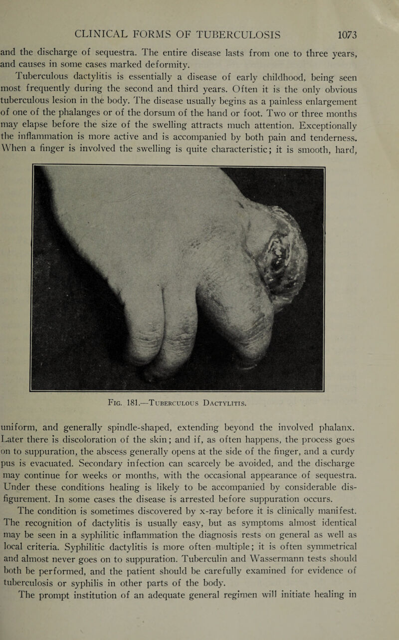 and the discharge of sequestra. The entire disease lasts from one to three years, and causes in some cases marked deformity. Tuberculous dactylitis is essentially a disease of early childhood, being seen most frequently during the second and third years. Often it is the only obvious tuberculous lesion in the body. The disease usually begins as a painless enlargement of one of the phalanges or of the dorsum of the hand or foot. Two or three months may elapse before the size of the swelling attracts much attention. Exceptionally the inflammation is more active and is accompanied by both pain and tenderness. When a finger is involved the swelling is quite characteristic; it is smooth, hard, Fig. 181.—Tuberculous Dactylitis. uniform, and generally spindle-shaped, extending beyond the involved phalanx. Later there is discoloration of the skin; and if, as often happens, the process goes on to suppuration, the abscess generally opens at the side of the finger, and a curdy pus is evacuated. Secondary infection can scarcely be avoided, and the discharge may continue for weeks or months, with the occasional appearance of sequestra. Under these conditions healing is likely to be accompanied by considerable dis¬ figurement. In some cases the disease is arrested before suppuration occurs. The condition is sometimes discovered by x-ray before it is clinically manifest. The recognition of dactylitis is usually easy, but as symptoms almost identical may be seen in a syphilitic inflammation the diagnosis rests on general as well as local criteria. Syphilitic dactylitis is more often multiple; it is often symmetrical and almost never goes on to suppuration. Tuberculin and Wassermann tests should both be performed, and the patient should be carefully examined for evidence of tuberculosis or syphilis in other parts of the body. The prompt institution of an adequate general regimen will initiate healing in