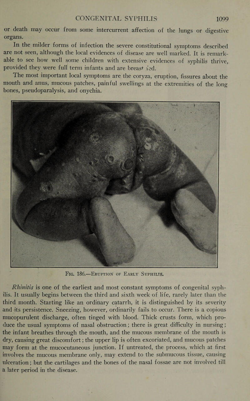 or death may occur from some intercurrent affection of the lungs or digestive organs. In the milder forms of infection the severe constitutional symptoms described are not seen, although the local evidences of disease are well marked. It is remark¬ able to see how well some children with extensive evidences of syphilis thrive, provided they were full term infants and are breast fed. The most important local symptoms are the coryza, eruption, fissures about the mouth and anus, mucous patches, painful swellings at the extremities of the long bones, pseudoparalysis, and onychia. Fig. 186.—Eruption of Early Syphilis. Rhinitis is one of the earliest and most constant symptoms of congenital syph¬ ilis. It usually begins between the third and sixth week of life, rarely later than the third month. Starting like an ordinary catarrh, it is distinguished by its severity and its persistence. Sneezing, however, ordinarily fails to occur. There is a copious mucopurulent discharge, often tinged with blood. Thick crusts form, which pro¬ duce the usual symptoms of nasal obstruction; there is great difficulty in nursing; the infant breathes through the mouth, and the mucous membrane of the mouth is dry, causing great discomfort; the upper lip is often excoriated, and mucous patches may form at the mucocutaneous junction. If untreated, the process, which at first involves the mucous membrane only, may extend to the submucous tissue, causing ulceration; but the cartilages and the bones of the nasal fossae are not involved till a later period in the disease.