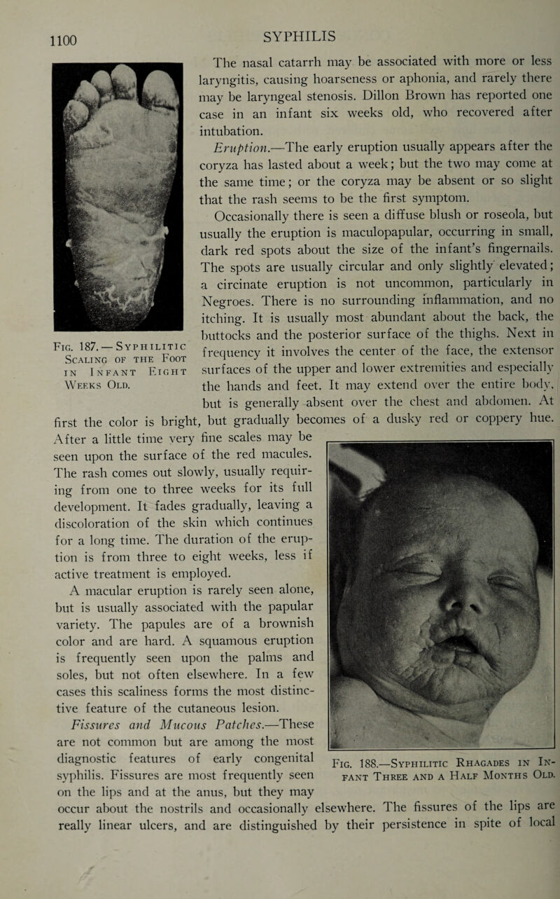 The nasal catarrh may be associated with more or less laryngitis, causing hoarseness or aphonia, and rarely there may be laryngeal stenosis. Dillon Brown has reported one case in an infant six weeks old, who recovered after intubation. Eruption.—The early eruption usually appears after the coryza has lasted about a week; but the two may come at the same time; or the coryza may be absent or so slight that the rash seems to be the first symptom. Occasionally there is seen a diffuse blush or roseola, but usually the eruption is maculopapular, occurring in small, dark red spots about the size of the infant’s fingernails. The spots are usually circular and only slightly elevated; a circinate eruption is not uncommon, particularly in Negroes. There is no surrounding inflammation, and no itching. It is usually most abundant about the back, the buttocks and the posterior surface of the thighs. Next in frequency it involves the center of the face, the extensor surfaces of the upper and lower extremities and especially the hands and feet. It may extend over the entire body, but is generally absent over the chest and abdomen. At first the color is bright, but gradually becomes of a dusky red or coppery hue. After a little time very fine scales may be seen upon the surface of the red macules. The rash comes out slowly, usually requir¬ ing from one to three weeks for its full development. It fades gradually, leaving a discoloration of the skin which continues for a long time. The duration of the erup¬ tion is from three to eight weeks, less if active treatment is employed. A macular eruption is rarely seen alone, but is usually associated with the papular variety. The papules are of a brownish color and are hard. A squamous eruption is frequently seen upon the palms and soles, but not often elsewhere. In a few cases this scaliness forms the most distinc¬ tive feature of the cutaneous lesion. Fissures and Mucous Patches.—These are not common but are among the most diagnostic features of early congenital syphilis. Fissures are most frequently seen on the lips and at the anus, but they may occur about the nostrils and occasionally elsewhere. The fissures of the lips are really linear ulcers, and are distinguished by their persistence in spite of local Fig. 187. — Syphilitic Scaling of the Foot in Infant Eight Weeks Old.