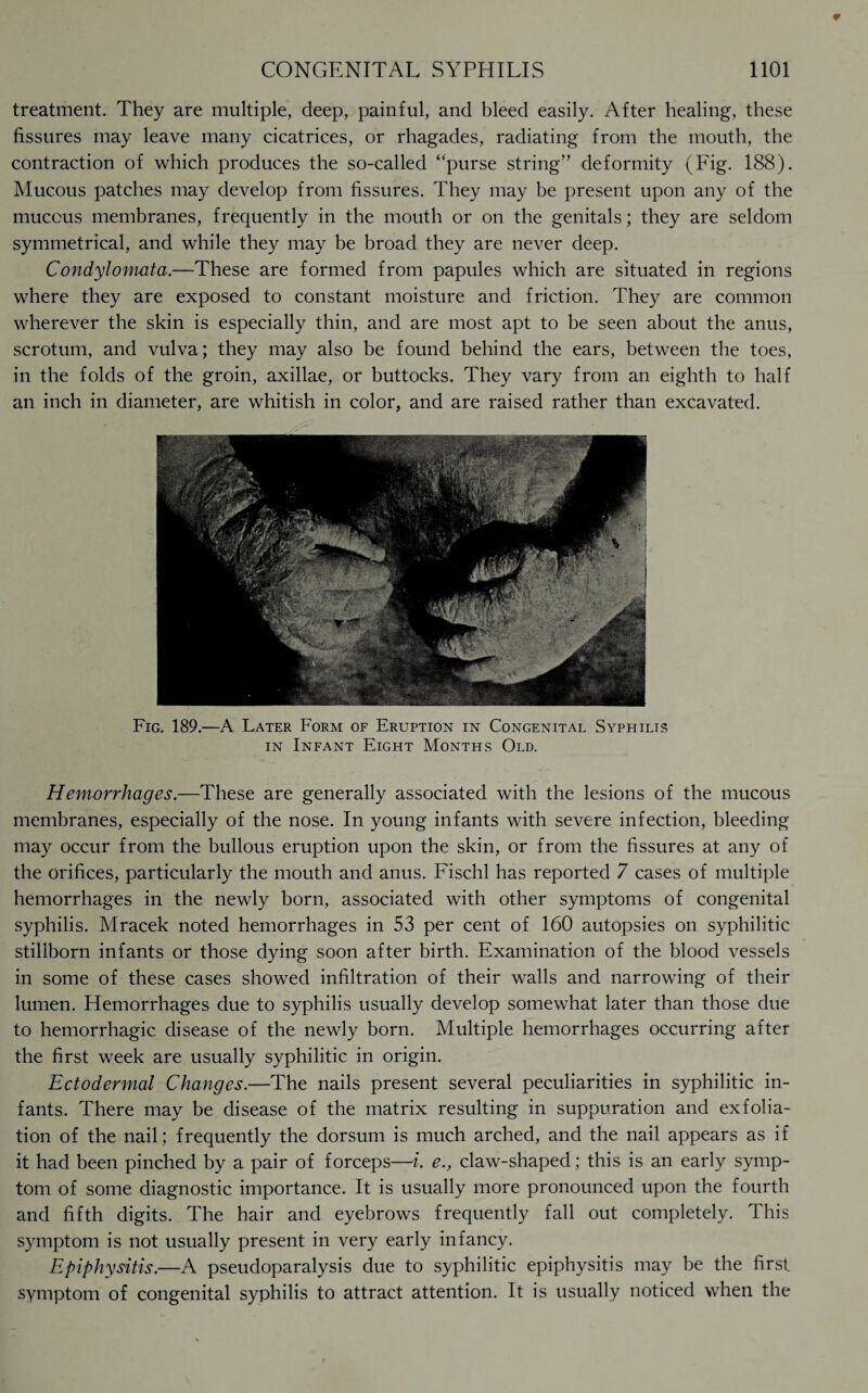 treatment. They are multiple, deep, painful, and bleed easily. After healing, these fissures may leave many cicatrices, or rhagades, radiating from the mouth, the contraction of which produces the so-called ‘‘purse string” deformity (Fig. 188). Mucous patches may develop from fissures. They may be present upon any of the mucous membranes, frequently in the mouth or on the genitals; they are seldom symmetrical, and while they may be broad they are never deep. Condylomata.—These are formed from papules which are situated in regions where they are exposed to constant moisture and friction. They are common wherever the skin is especially thin, and are most apt to be seen about the anus, scrotum, and vulva; they may also be found behind the ears, between the toes, in the folds of the groin, axillae, or buttocks. They vary from an eighth to half an inch in diameter, are whitish in color, and are raised rather than excavated. Fig. 189.—A Later Form of Eruption in Congenital Syphilis in Infant Eight Months Old. Hemorrhages.—These are generally associated with the lesions of the mucous membranes, especially of the nose. In young infants with severe infection, bleeding may occur from the bullous eruption upon the skin, or from the fissures at any of the orifices, particularly the mouth and anus. Fischl has reported 7 cases of multiple hemorrhages in the newly born, associated with other symptoms of congenital syphilis. Mracek noted hemorrhages in 53 per cent of 160 autopsies on syphilitic stillborn infants or those dying soon after birth. Examination of the blood vessels in some of these cases showed infiltration of their walls and narrowing of their lumen. Hemorrhages due to syphilis usually develop somewhat later than those due to hemorrhagic disease of the newly born. Multiple hemorrhages occurring after the first week are usually syphilitic in origin. Ectodermal Changes.—The nails present several peculiarities in syphilitic in¬ fants. There may be disease of the matrix resulting in suppuration and exfolia¬ tion of the nail; frequently the dorsum is much arched, and the nail appears as if it had been pinched by a pair of forceps—i. e., claw-shaped; this is an early symp¬ tom of some diagnostic importance. It is usually more pronounced upon the fourth and fifth digits. The hair and eyebrows frequently fall out completely. This symptom is not usually present in very early infancy. Epiphysitis.—A pseudoparalysis due to syphilitic epiphysitis may be the first, symptom of congenital syphilis to attract attention. It is usually noticed when the