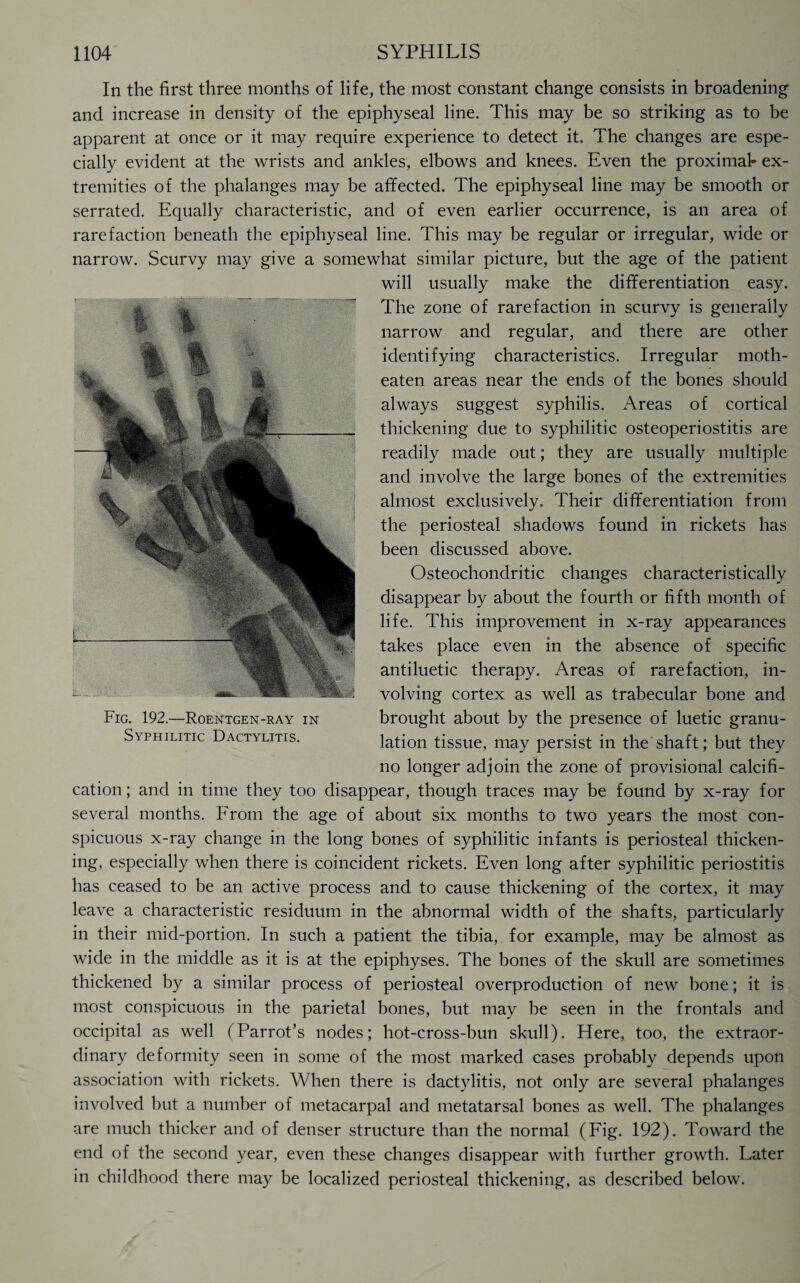 In the first three months of life, the most constant change consists in broadening and increase in density of the epiphyseal line. This may be so striking as to be apparent at once or it may require experience to detect it. The changes are espe¬ cially evident at the wrists and ankles, elbows and knees. Even the proximal- ex¬ tremities of the phalanges may be affected. The epiphyseal line may be smooth or serrated. Equally characteristic, and of even earlier occurrence, is an area of rarefaction beneath the epiphyseal line. This may be regular or irregular, wide or narrow. Scurvy may give a somewhat similar picture, but the age of the patient will usually make the differentiation easy. The zone of rarefaction in scurvy is generally narrow and regular, and there are other identifying characteristics. Irregular moth- eaten areas near the ends of the bones should always suggest syphilis. Areas of cortical thickening due to syphilitic osteoperiostitis are readily made out; they are usually multiple and involve the large bones of the extremities almost exclusively. Their differentiation from the periosteal shadows found in rickets has been discussed above. Osteochondritic changes characteristically disappear by about the fourth or fifth month of life. This improvement in x-ray appearances takes place even in the absence of specific antiluetic therapy. Areas of rarefaction, in¬ volving cortex as well as trabecular bone and brought about by the presence of luetic granu¬ lation tissue, may persist in the shaft; but they no longer adjoin the zone of provisional calcifi¬ cation ; and in time they too disappear, though traces may be found by x-ray for several months. From the age of about six months to two years the most con¬ spicuous x-ray change in the long bones of syphilitic infants is periosteal thicken¬ ing, especially when there is coincident rickets. Even long after syphilitic periostitis has ceased to be an active process and to cause thickening of the cortex, it may leave a characteristic residuum in the abnormal width of the shafts, particularly in their mid-portion. In such a patient the tibia, for example, may be almost as wide in the middle as it is at the epiphyses. The bones of the skull are sometimes thickened by a similar process of periosteal overproduction of new bone; it is most conspicuous in the parietal bones, but may be seen in the frontals and occipital as well (Parrot’s nodes; hot-cross-bun skull). Here, too, the extraor¬ dinary deformity seen in some of the most marked cases probably depends upon association with rickets. When there is dactylitis, not only are several phalanges involved but a number of metacarpal and metatarsal bones as well. The phalanges are much thicker and of denser structure than the normal (Fig. 192). Toward the end of the second year, even these changes disappear with further growth. Later in childhood there may be localized periosteal thickening, as described below. Fig. 192.—Roentgen-ray in Syphilitic Dactylitis.