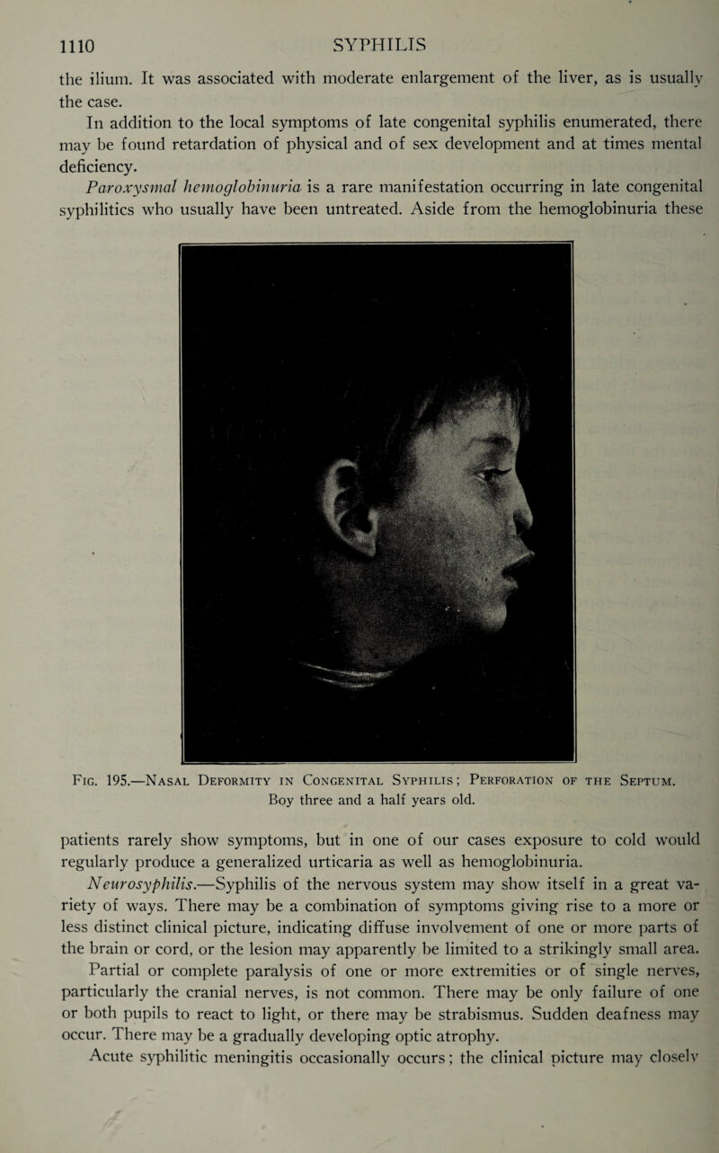 the ilium. It was associated with moderate enlargement of the liver, as is usually the case. In addition to the local symptoms of late congenital syphilis enumerated, there may be found retardation of physical and of sex development and at times mental deficiency. Paroxysmal hemoglobinuria is a rare manifestation occurring in late congenital syphilitics who usually have been untreated. Aside from the hemoglobinuria these Fig. 195.—Nasal Deformity in Congenital Syphilis; Perforation of the Septum. Boy three and a half years old. patients rarely show symptoms, but in one of our cases exposure to cold would regularly produce a generalized urticaria as well as hemoglobinuria. Neurosyphilis.—Syphilis of the nervous system may show itself in a great va¬ riety of ways. There may be a combination of symptoms giving rise to a more or less distinct clinical picture, indicating diffuse involvement of one or more parts of the brain or cord, or the lesion may apparently be limited to a strikingly small area. Partial or complete paralysis of one or more extremities or of single nerves, particularly the cranial nerves, is not common. There may be only failure of one or both pupils to react to light, or there may be strabismus. Sudden deafness may occur. There may be a gradually developing optic atrophy. Acute syphilitic meningitis occasionally occurs; the clinical picture may closelv
