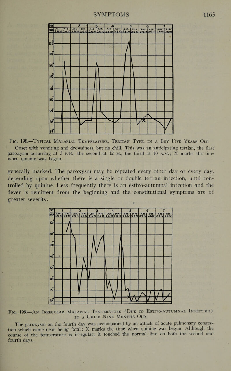 Fig. 198.—Typical Malarial Temperature, Tertian Type, in a Boy Five Years Old. Onset with vomiting and drowsiness, but no chill. This was an anticipating tertian, the first paroxysm occurring at 3 p.m., the second at 12 M., the third at 10 a.m. ; X marks the time when quinine was begun. generally marked. The paroxysm may be repeated every other day or every day, depending upon whether there is a single or double tertian infection, until con¬ trolled by quinine. Less frequently there is an estivo-autumnal infection and the fever is remittent from the beginning and the constitutional symptoms are of greater severity. Fig. 199_An Irregular Malarial Temperature (Due to Estivo-autumnal Infection) in a Child Nine Months Old. The paroxysm on the fourth day was accompanied by an attack of acute pulmonary conges¬ tion which came near being fatal; X marks the time when quinine was begun. Although the course of the temperature is irregular, it touched the normal line on both the second and fourth days.