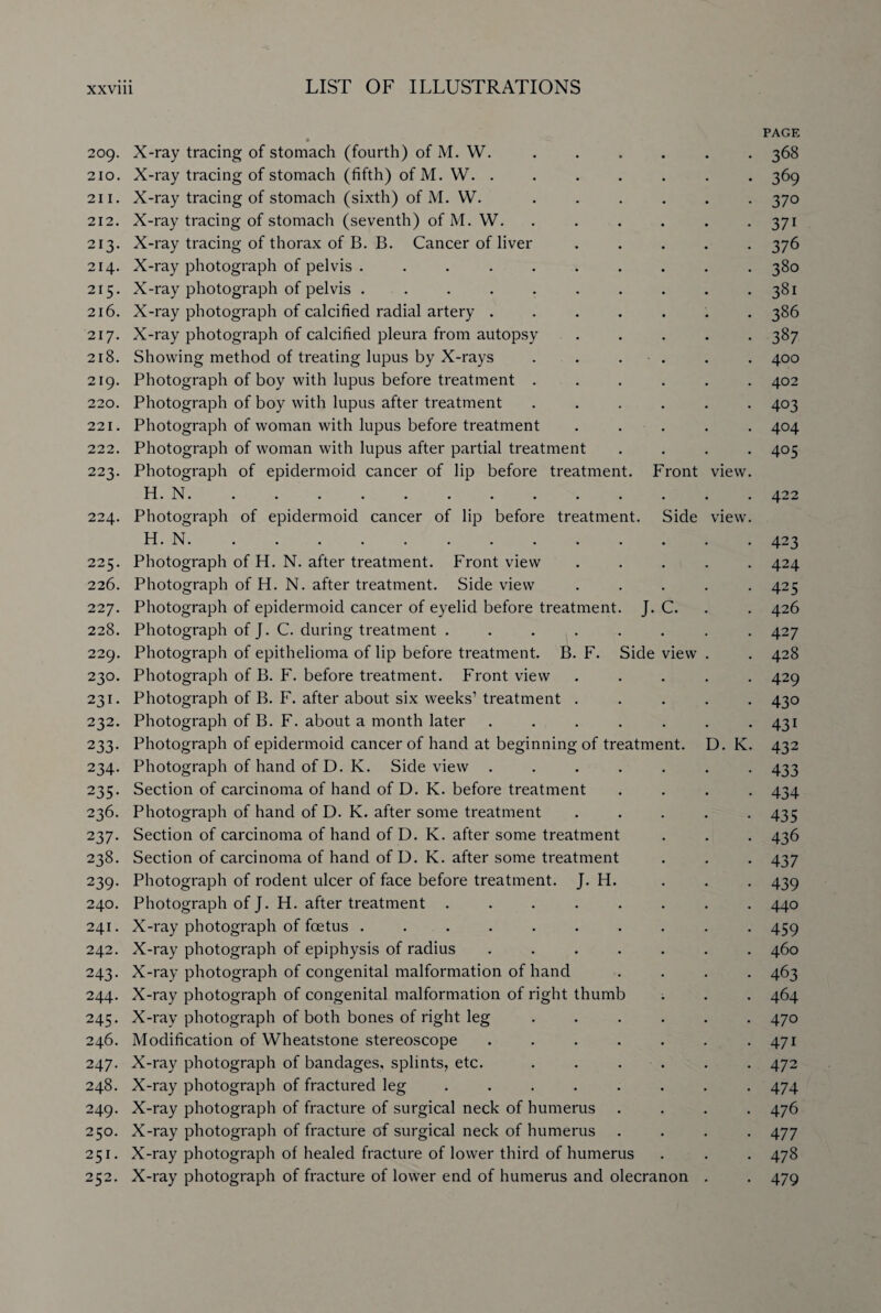 PAGE 209. X-ray tracing of stomach (fourth) of M. W. ...... 368 210. X-ray tracing of stomach (fifth) of M. W. ....... 369 211. X-ray tracing of stomach (sixth) of M. W. ...... 370 212. X-ray tracing of stomach (seventh) ofM. W. ...... 371 213. X-ray tracing of thorax of B. B. Cancer of liver ..... 376 214. X-ray photograph of pelvis .......... 380 215. X-ray photograph of pelvis . . . . . . . . . -381 216. X-ray photograph of calcified radial artery ....... 386 217. X-ray photograph of calcified pleura from autopsy ..... 387 218. Showing method of treating lupus by X-rays . . . . . . 400 219. Photograph of boy with lupus before treatment ...... 402 220. Photograph of boy with lupus after treatment ...... 403 221. Photograph of woman with lupus before treatment ..... 404 222. Photograph of woman with lupus after partial treatment .... 405 223. Photograph of epidermoid cancer of lip before treatment. Front view. H. N. ............ 422 224. Photograph of epidermoid cancer of lip before treatment. Side view. H. N. ............ 423 225. Photograph of H. N. after treatment. Front view ..... 424 226. Photograph of H. N. after treatment. Side view ..... 425 227. Photograph of epidermoid cancer of eyelid before treatment. J. C. . 426 228. Photograph of J. C. during treatment ........ 427 229. Photograph of epithelioma of lip before treatment. B. F. Side view . . 428 230. Photograph of B. F. before treatment. Front view ..... 429 231. Photograph of B. F. after about six weeks1 treatment ..... 430 232. Photograph of B. F. about a month later ....... 431 233. Photograph of epidermoid cancer of hand at beginning of treatment. D. K. 432 234. Photograph of hand of D. K. Side view ....... 433 235. Section of carcinoma of hand of D. K. before treatment .... 434 236. Photograph of hand of D. K. after some treatment ..... 435 237. Section of carcinoma of hand of D. K. after some treatment . . . 436 238. Section of carcinoma of hand of D. K. after some treatment . . . 437 239. Photograph of rodent ulcer of face before treatment. J. H. . . . 439 240. Photograph of J. H. after treatment ........ 440 241. X-ray photograph of foetus .......... 459 242. X-ray photograph of epiphysis of radius ....... 460 243. X-ray photograph of congenital malformation of hand .... 463 244. X-ray photograph of congenital malformation of right thumb . . . 464 245. X-ray photograph of both bones of right leg ...... 470 246. Modification of Wheatstone stereoscope . . . . . . -471 247. X-ray photograph of bandages, splints, etc. ...... 472 248. X-ray photograph of fractured leg ........ 474 249. X-ray photograph of fracture of surgical neck of humerus .... 476 250. X-ray photograph of fracture of surgical neck of humerus .... 477 251. X-ray photograph of healed fracture of lower third of humerus . . . 478 252. X-ray photograph of fracture of lower end of humerus and olecranon . . 479