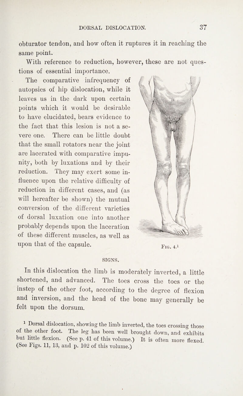 obturator tendon, and how often it ruptures it in reaching the same point. With reference to reduction, however, these are not ques¬ tions of essential importance. The comparative infrequency of autopsies of hip dislocation, while it leaves us in the dark upon certain points which it would be desirable to have elucidated, bears evidence to the fact that this lesion is not a se¬ vere one. There can be little doubt that the small rotators near the joint are lacerated with comparative impu¬ nity, both by luxations and by their reduction. They may exert some in¬ fluence upon the relative difficulty of reduction in different cases, and (as will hereafter be shown) the mutual conversion of the different varieties of dorsal luxation one into another probably depends upon the laceration of these different muscles, as well as upon that of the capsule. SIGNS. In this dislocation the limb is moderately inverted, a little shortened, and advanced. The toes cross the toes or the instep of the other foot, according to the degree of flexion and inversion, and the head of the bone may generally be felt upon the dorsum. 1 Dorsal dislocation, showing the limb inverted, the toes crossing those of the other foot. The leg has been well brought down, and exhibits but little flexion. (See p. 41 of this volume.) It is often more flexed. (See Figs. 11, 13, and p. 102 of this volume.)