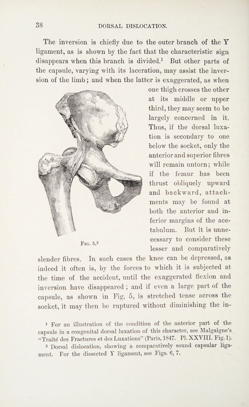 The inversion is chiefly due to the outer branch of the Y ligament, as is shown by the fact that the characteristic sign disappears when this branch is divided.1 2 But other parts of the capsule, varying with its laceration, may assist the inver¬ sion of the limb; and when the latter is exaggerated, as when one thigh crosses the other at its middle or upper third, they may seem to be largely concerned in it. Thus, if the dorsal luxa¬ tion is secondary to one below the socket, only the anterior and superior fibres will remain untorn; while if the femur has been thrust obliquely upward and backward, attach¬ ments may be found at both the anterior and in¬ ferior margins of the ace¬ tabulum. But it is unne¬ cessary to consider these lesser and comparatively slender fibres. In such cases the knee can be depressed, as indeed it often is, by the forces to which it is subjected at the time of the accident, until the exaggerated flexion and inversion have disappeared ; and if even a large part of the capsule, as shown in Fig. 5, is stretched tense across the socket, it may then be ruptured without diminishing the in- Fig. 5.2 1 For an illustration of the condition of the anterior part of the capsule in a congenital dorsal luxation of this character, see Malgaigne’s “Traite des Fractures et des Luxations” (Paris, 1847. PI. XXVIII. Fig. 1). 2 Dorsal dislocation, showing a comparatively sound capsular liga¬ ment. For the dissected Y ligament, see Figs. 6, 7.